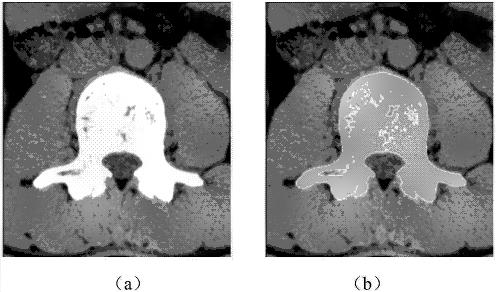 Automatic spine feature point recognition method based on Gauss curvature flow