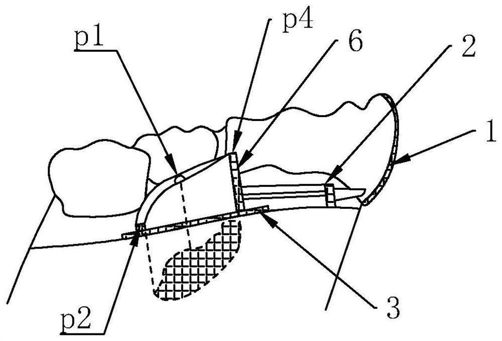 A positioning guide plate for extraction of embedded supernumerary teeth in anterior region and its manufacturing method