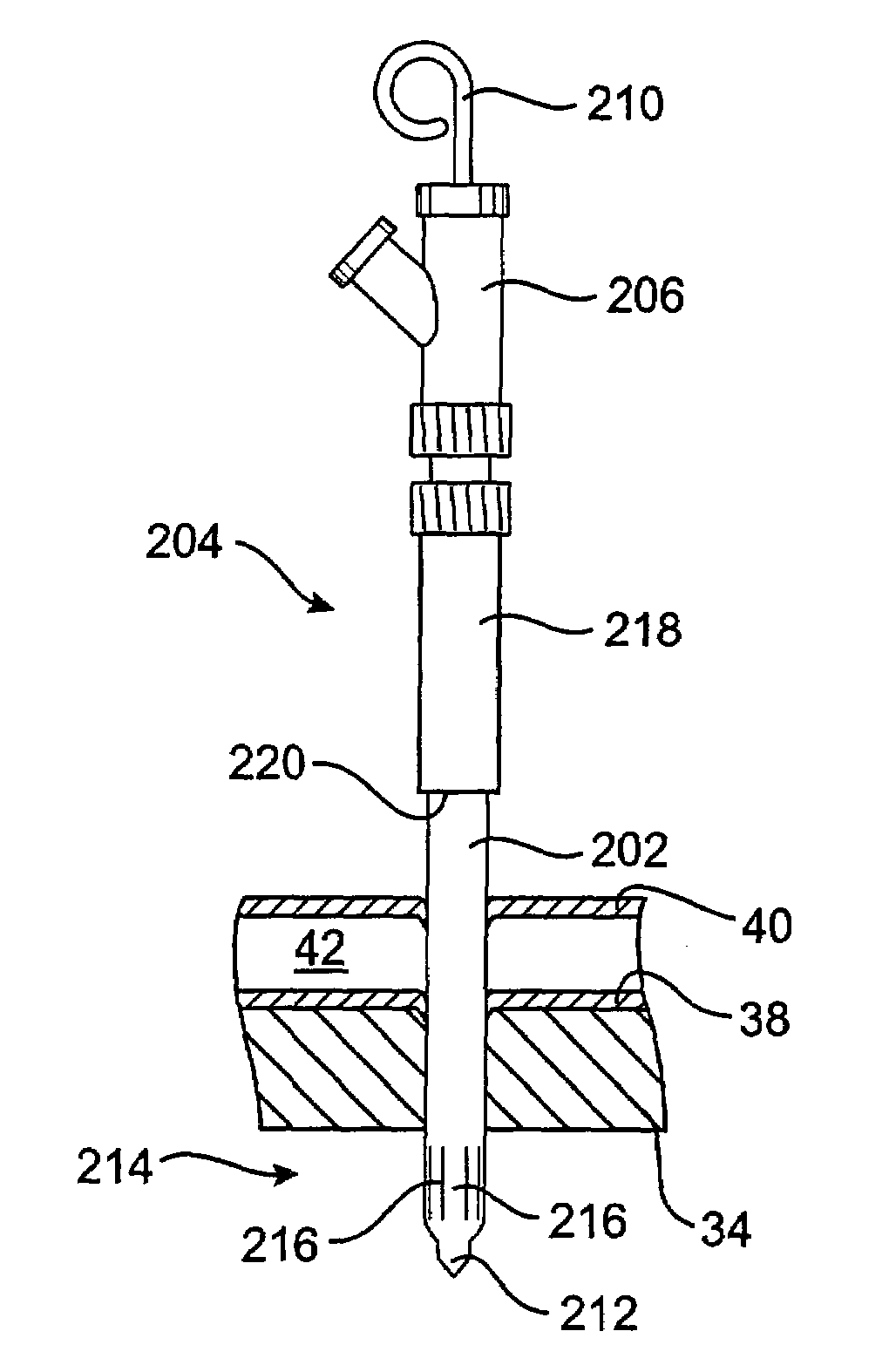 Delivering a conduit into a heart wall to place a coronary vessel in communication with a heart chamber and removing tissue from the vessel or heart wall to facilitate such communication