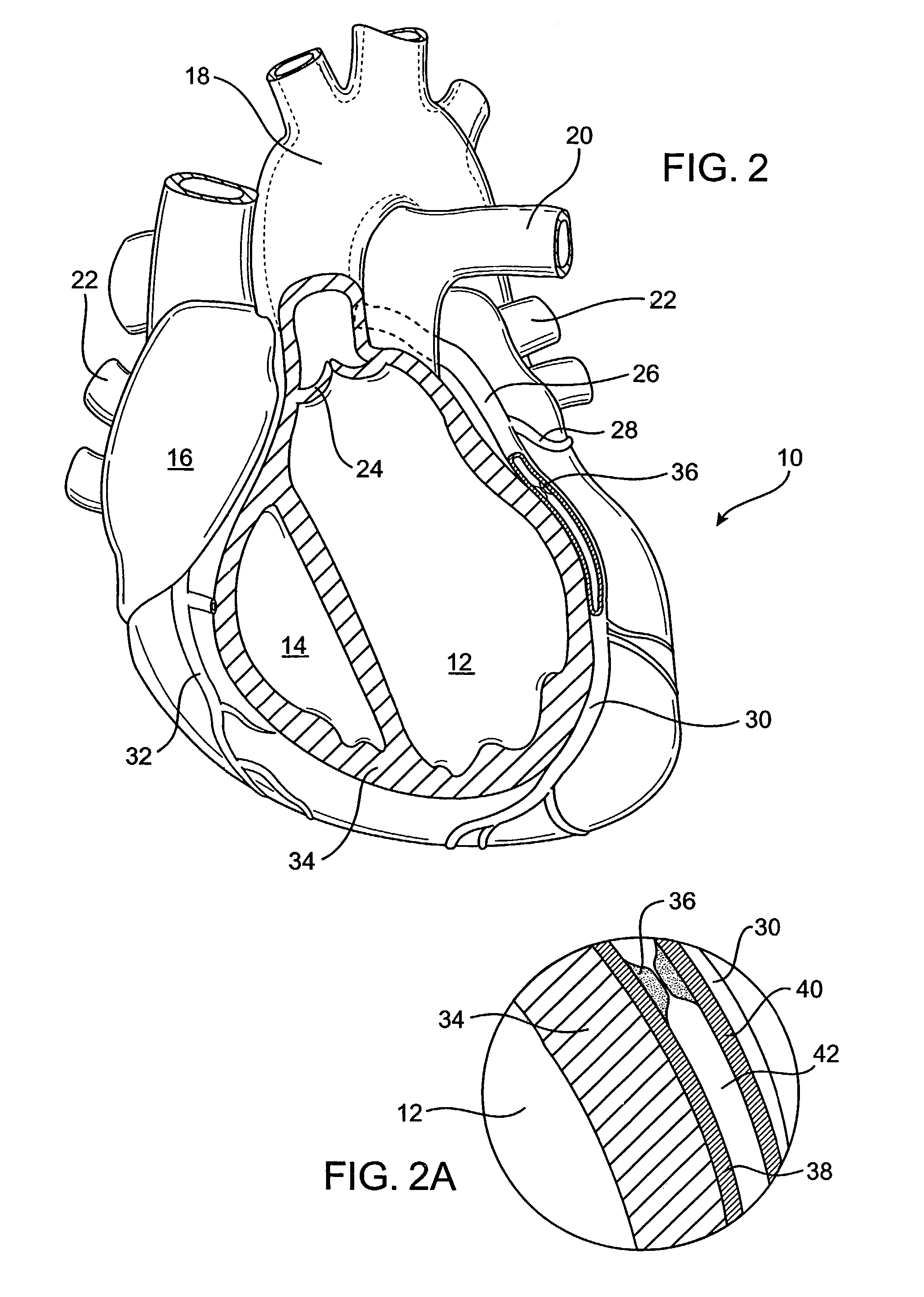 Delivering a conduit into a heart wall to place a coronary vessel in communication with a heart chamber and removing tissue from the vessel or heart wall to facilitate such communication