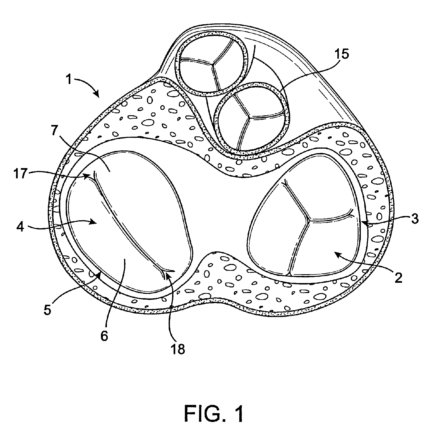 Cardiac valve annulus restraining device