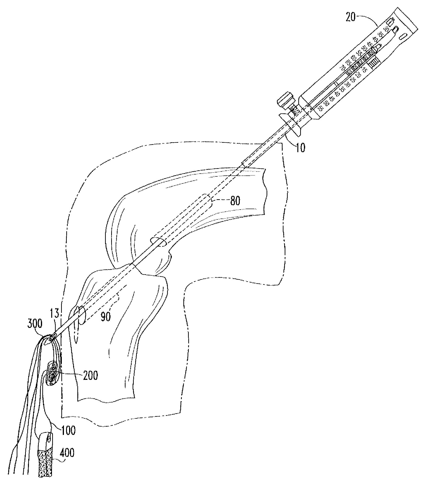 Device And Method For Use During Ligament Reconstruction Surgery