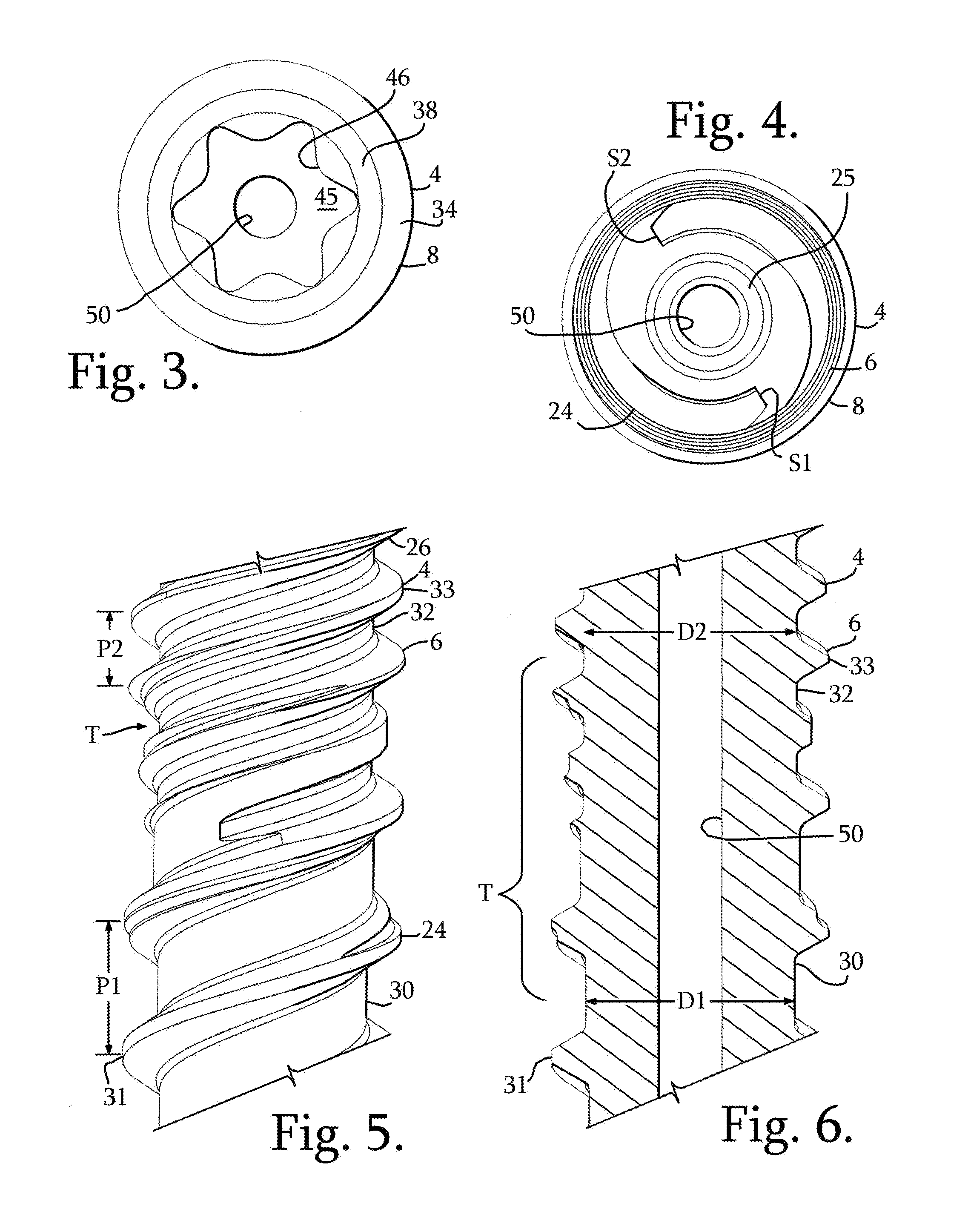 Polyaxial bone anchor with pop-on multi-thread shank, some with diametric interference fit inserts