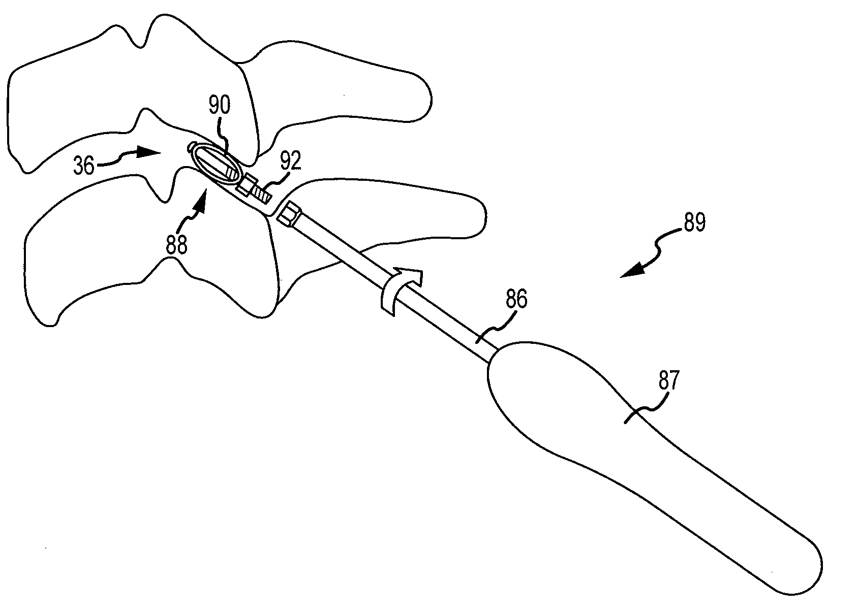 Cervical distraction/implant delivery device