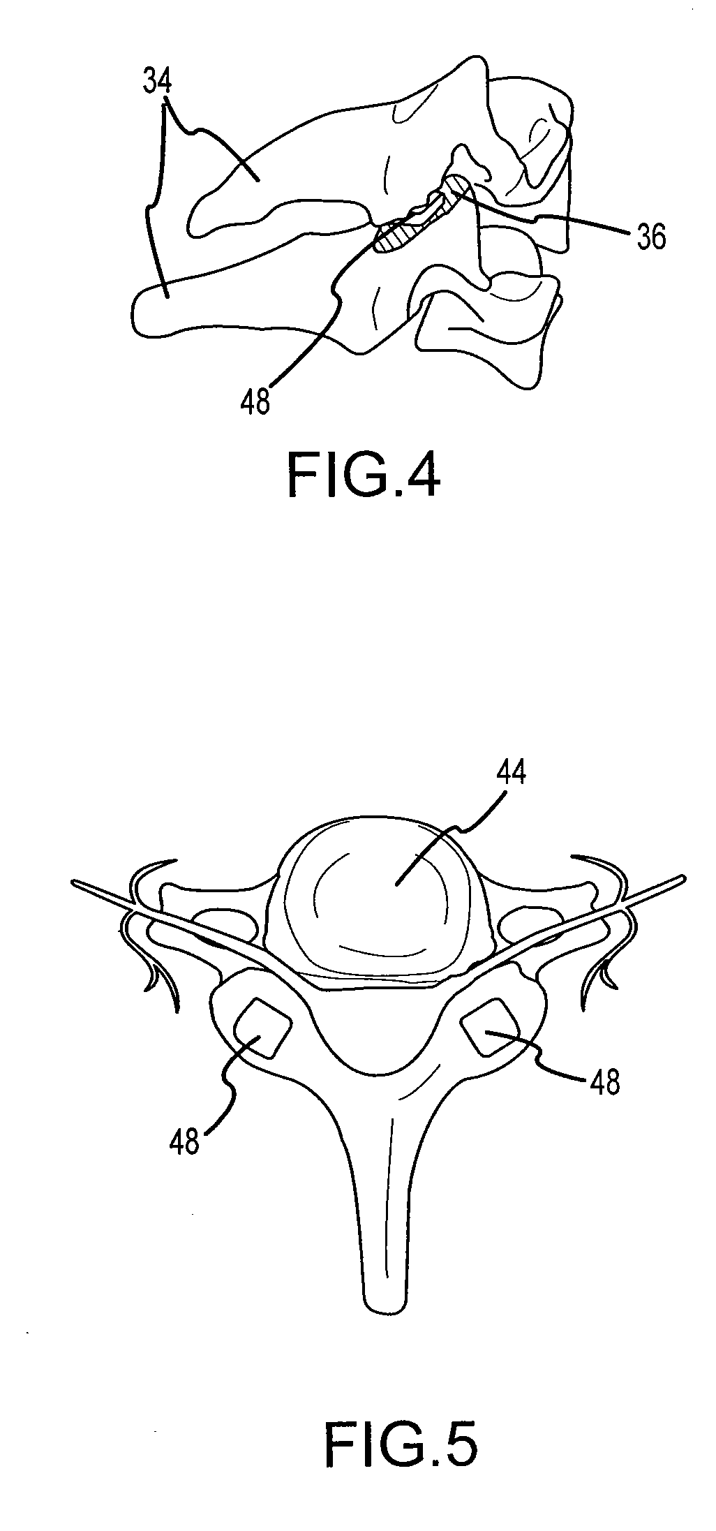 Cervical distraction/implant delivery device