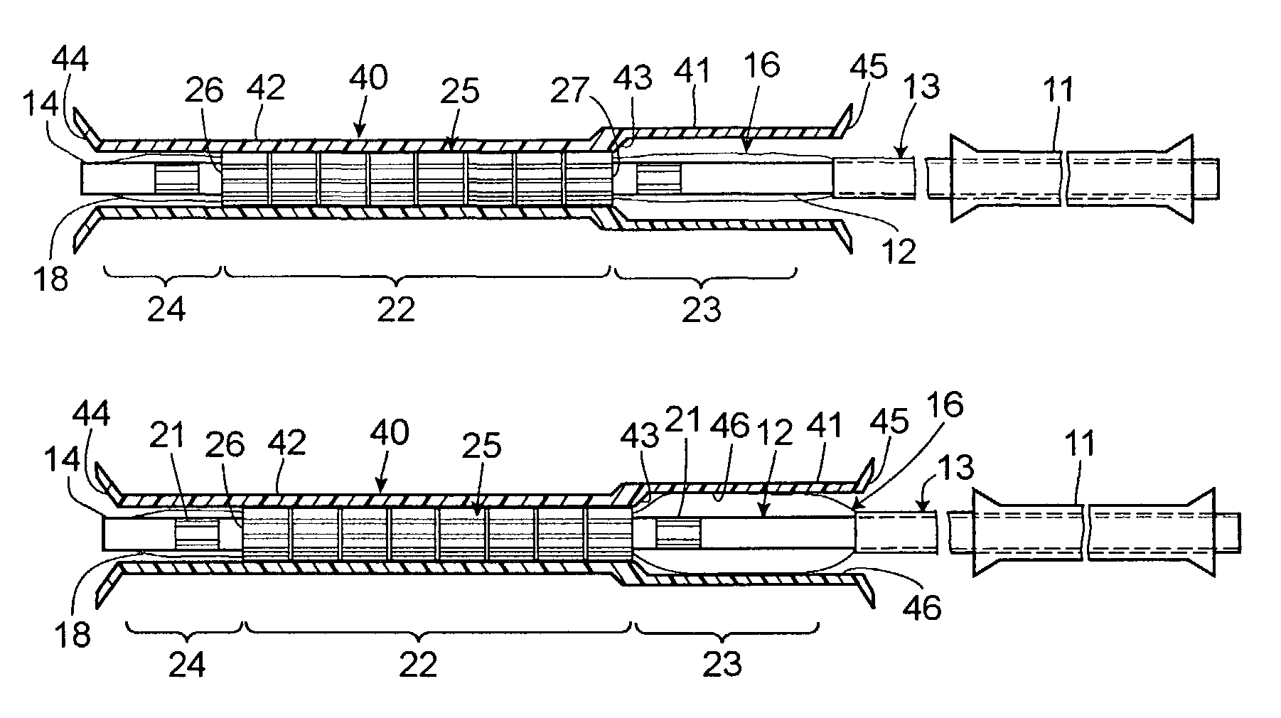 Asymmetric stent delivery system with proximal edge protection and method of manufacture thereof