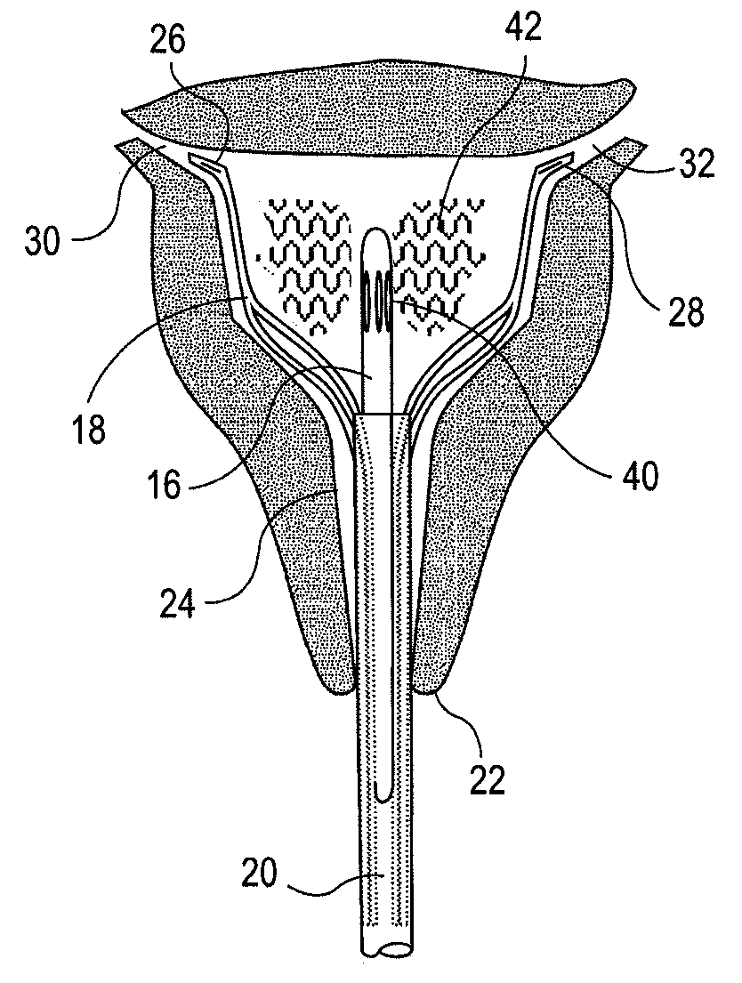 Uterine Therapy Device and Method