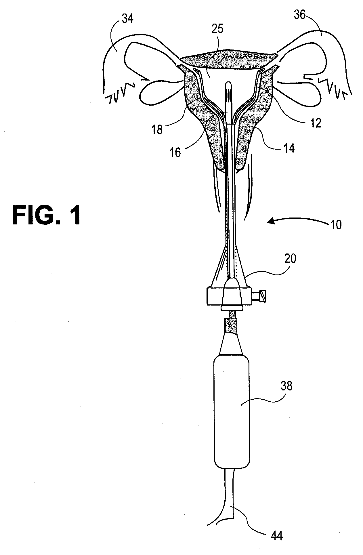 Uterine Therapy Device and Method