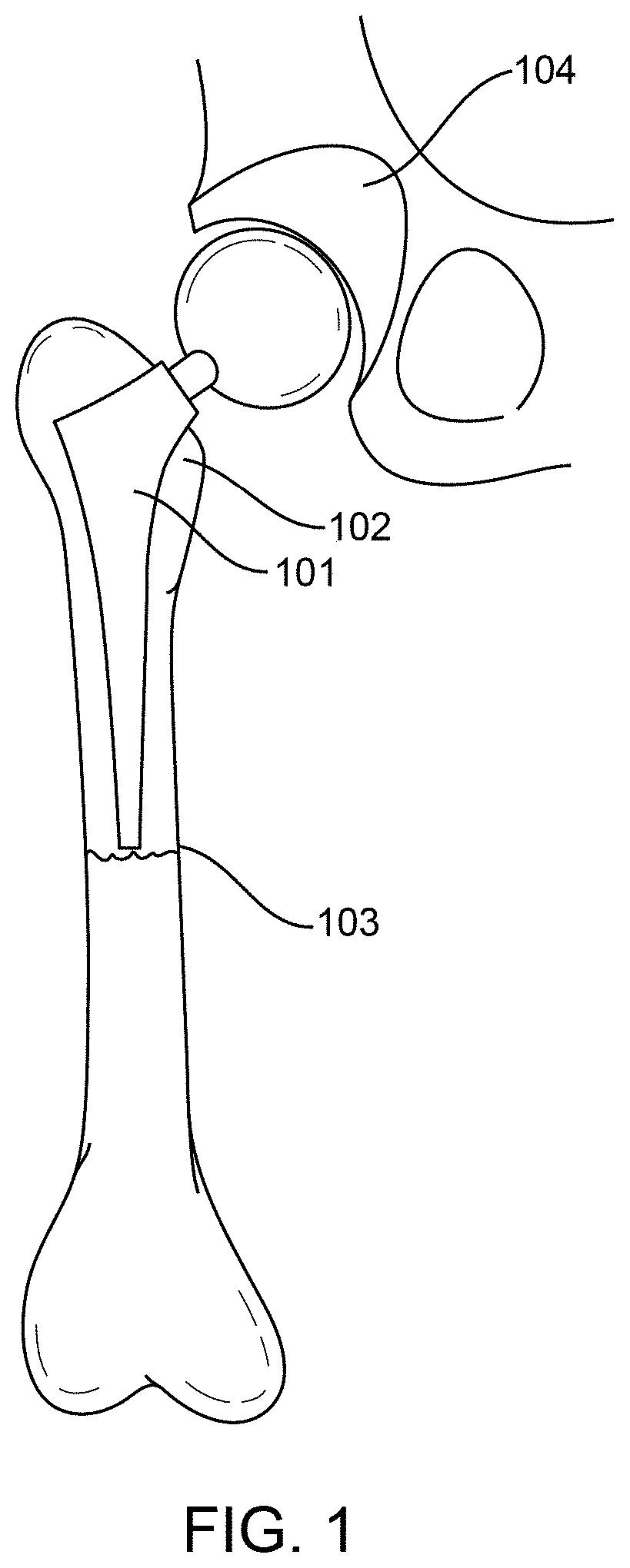 Periprosthetic shoulder fracture repair