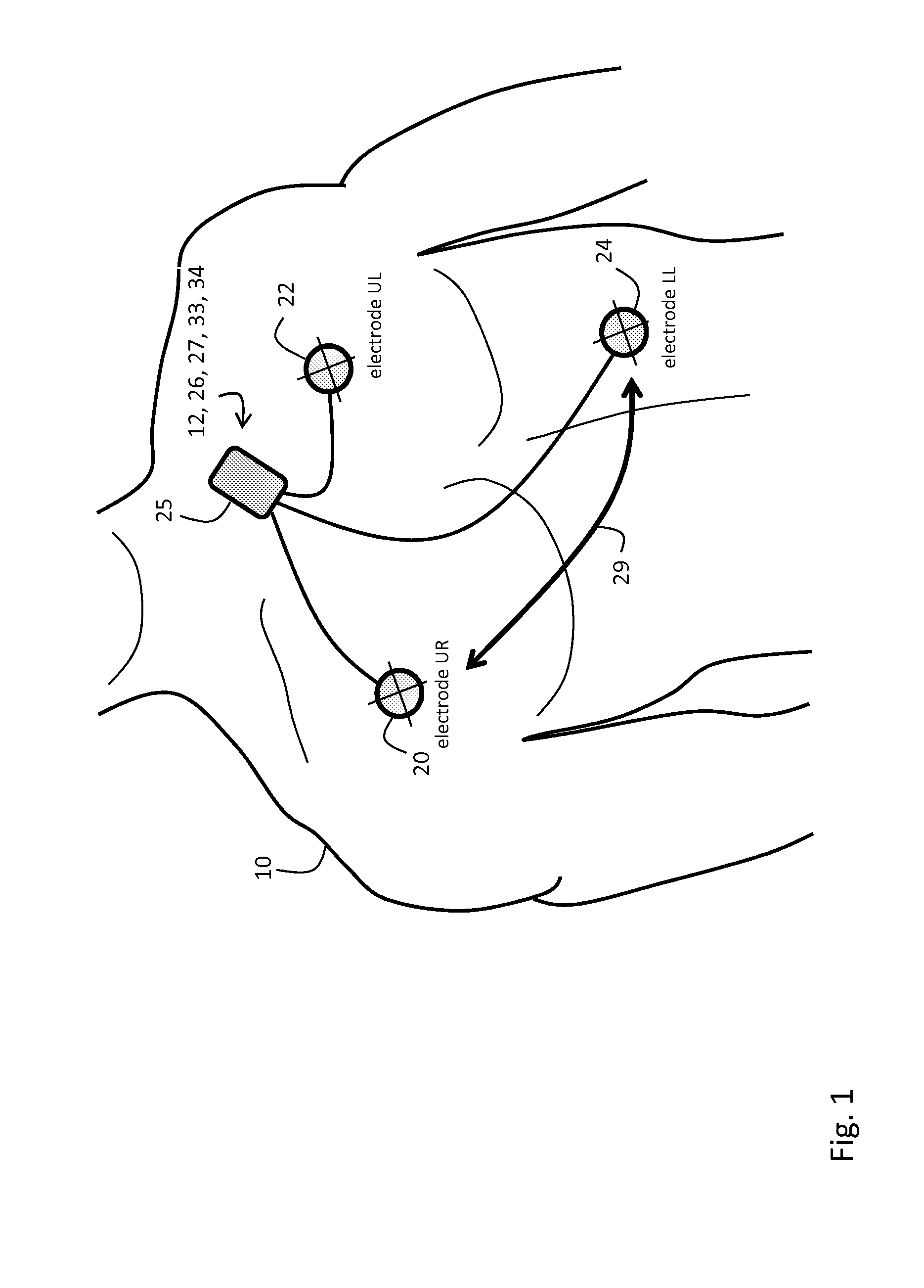 Body-worn monitor for measuring respiratory rate