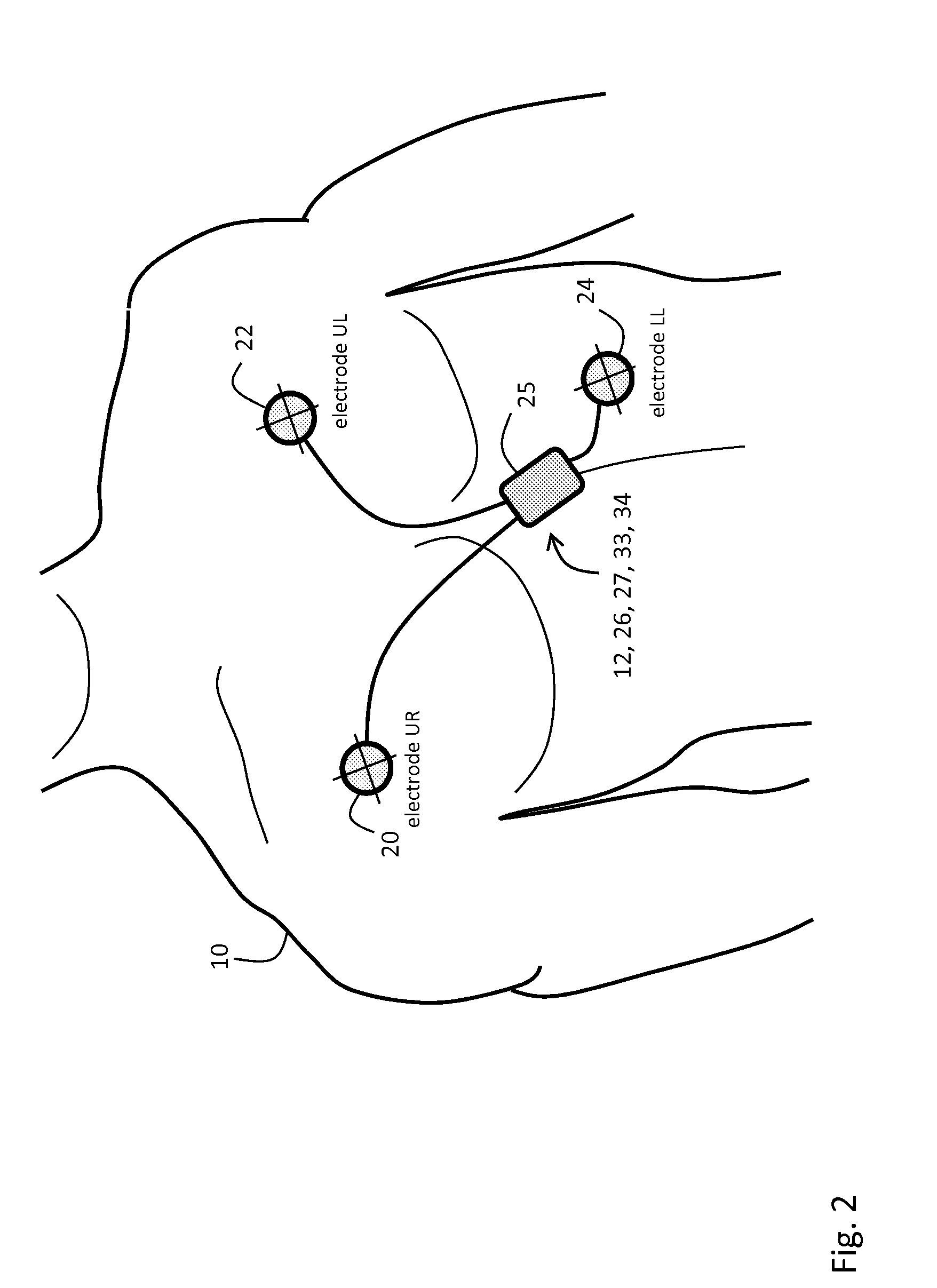 Body-worn monitor for measuring respiratory rate