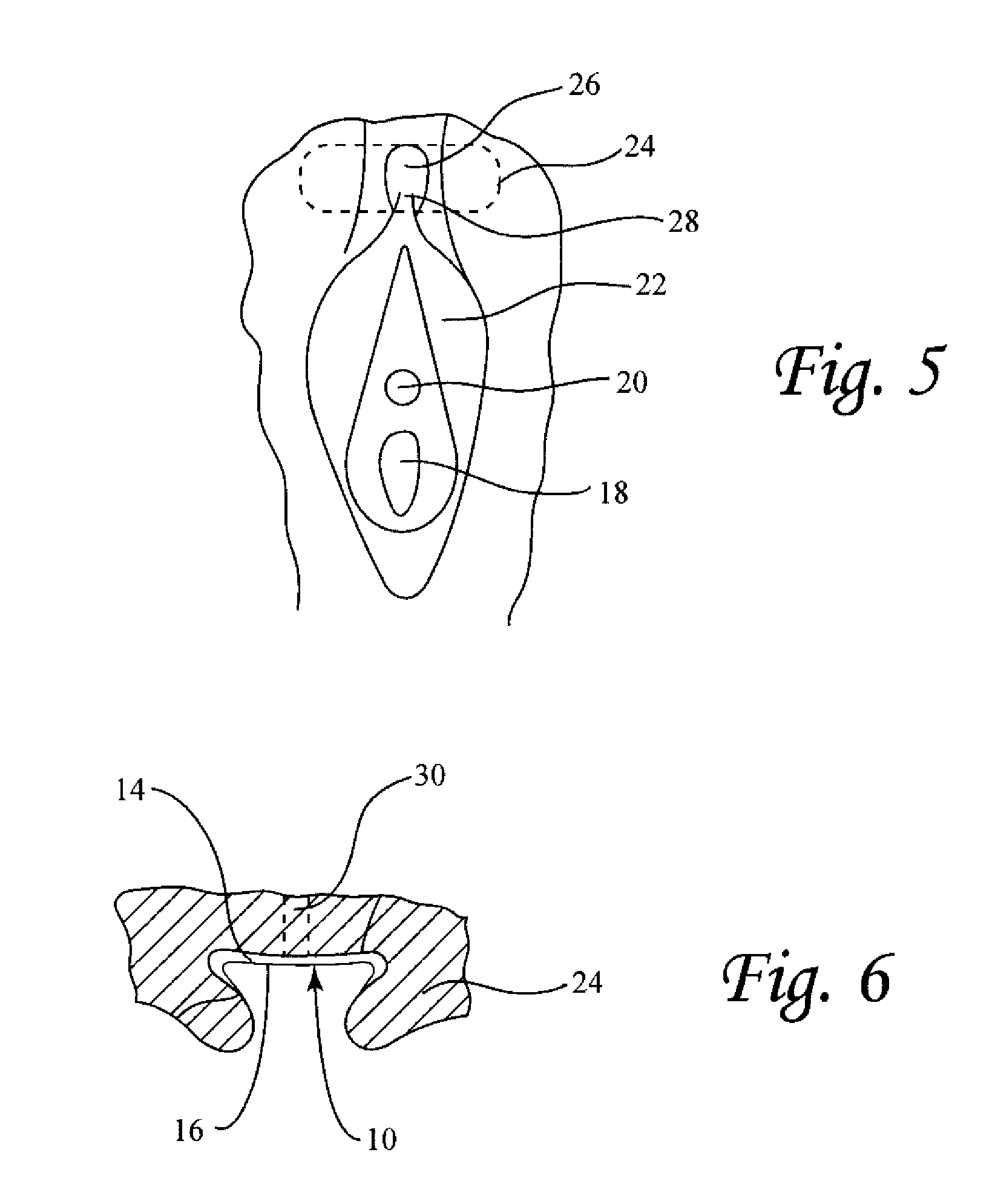 Method and device for female urinary incontinence