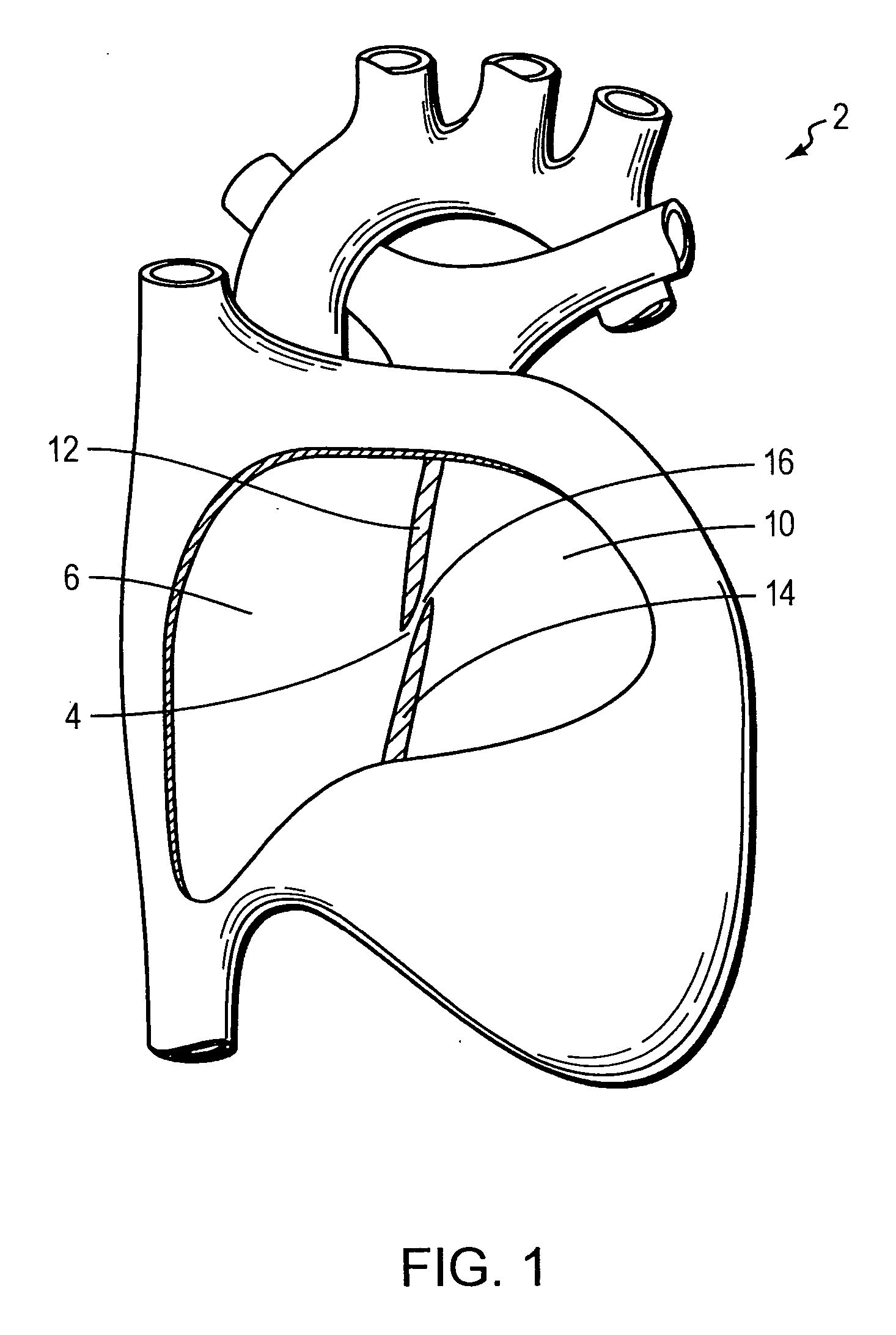 Delivery device for implant with dual attachment sites