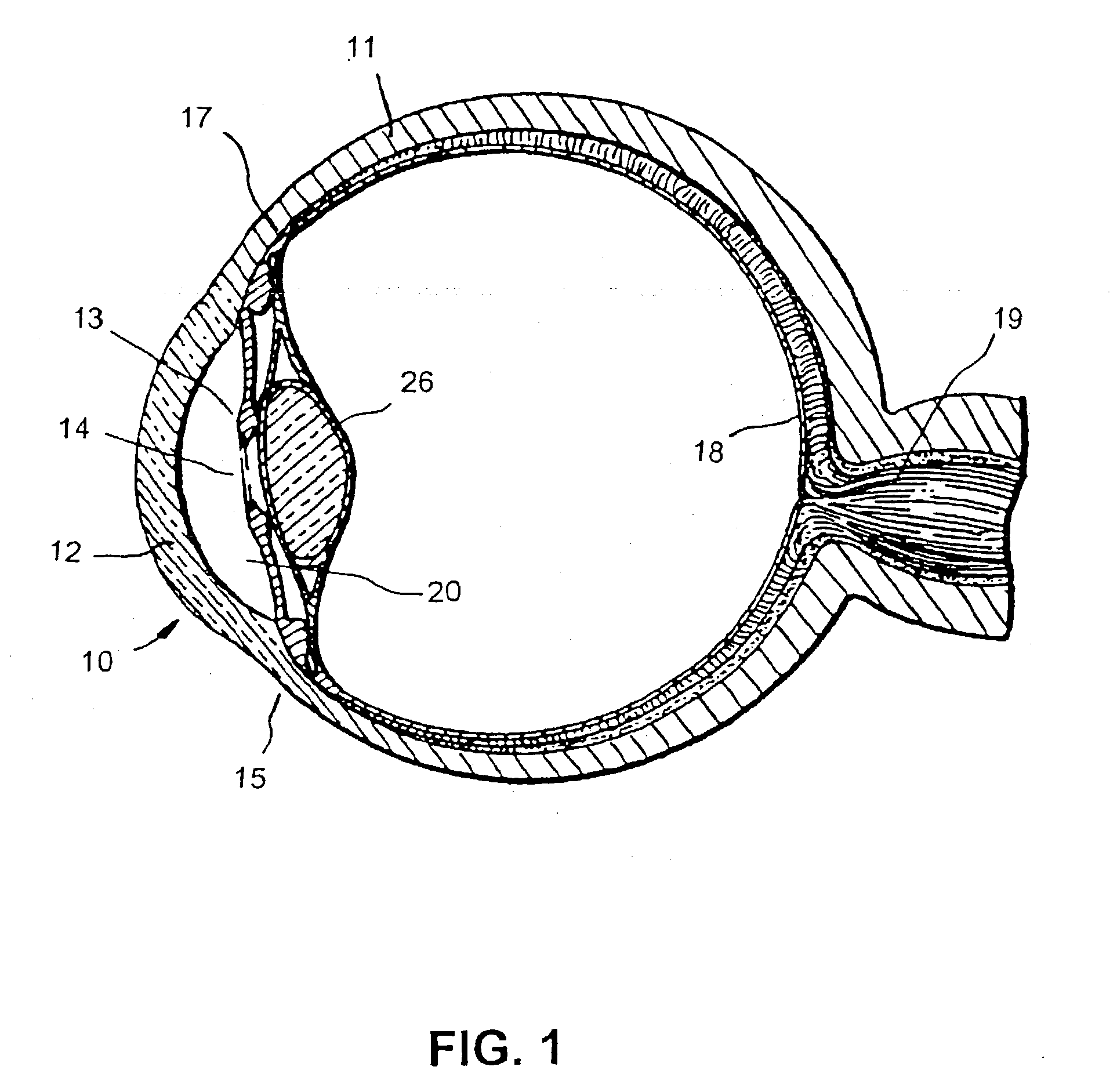 Expandable glaucoma implant and methods of use