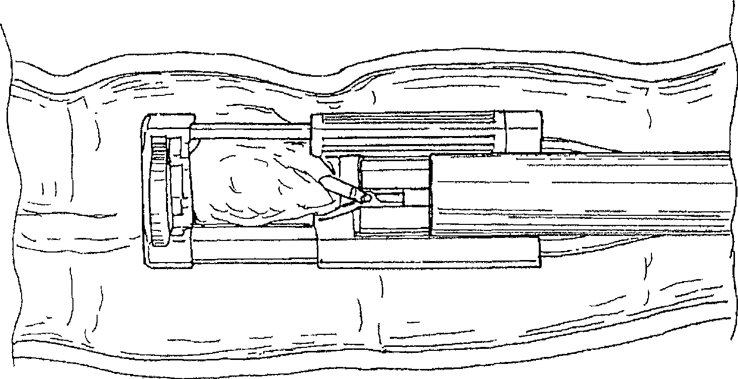 Device for endoluminally or laparoscopically grasping and excising a tissue sample from areas in a patient's body