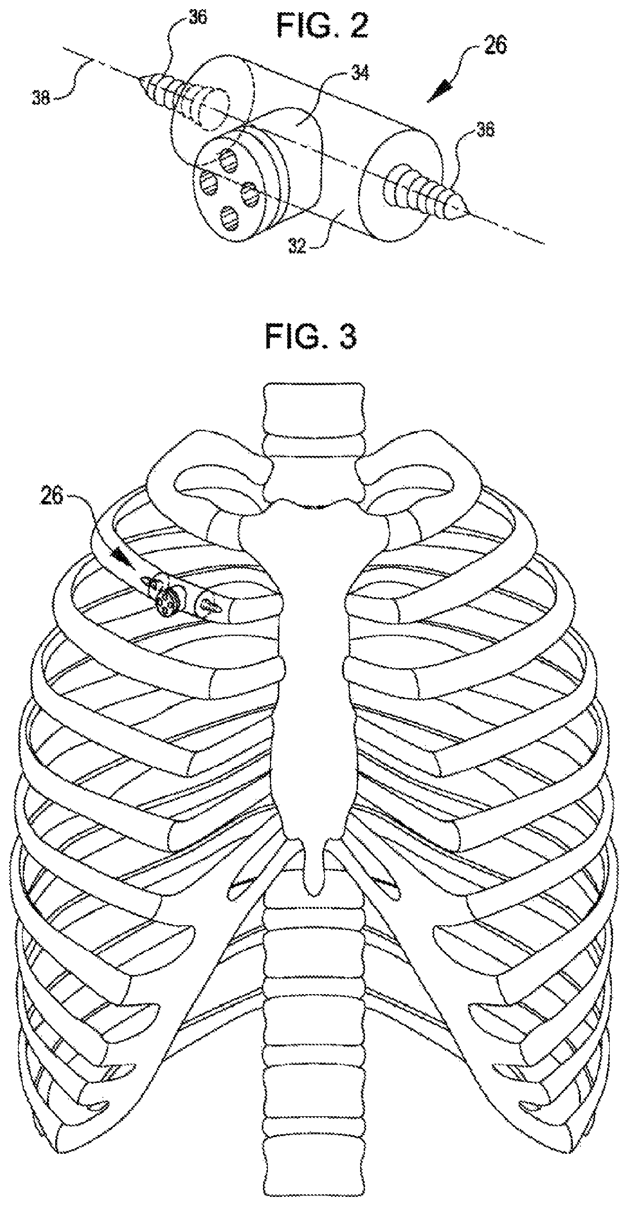 Prosthetic rib with integrated percutaneous connector for ventricular assist devices