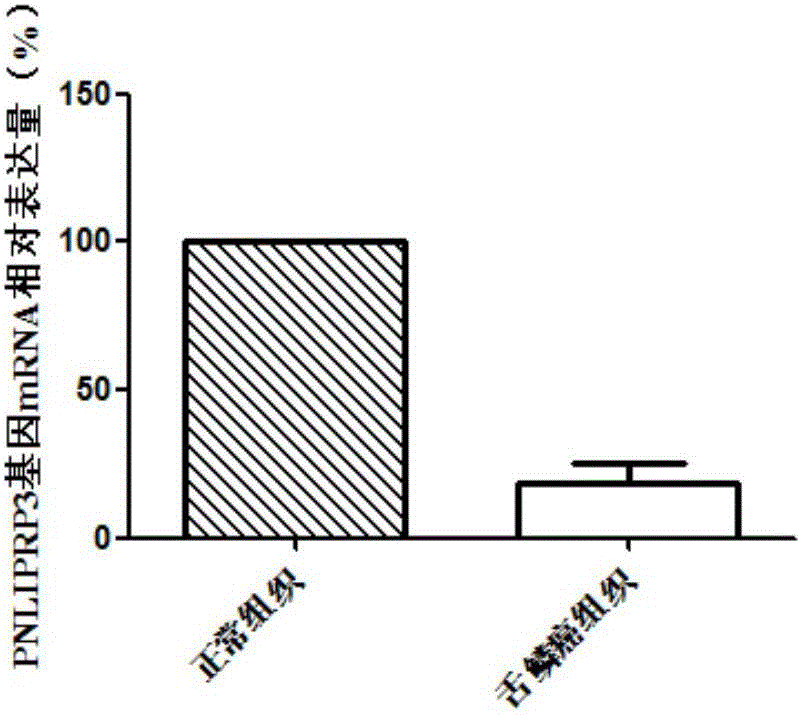 PNLIPRP3 gene and application of expression product of gene in tongue squamous carcinoma diagnosis and treatment