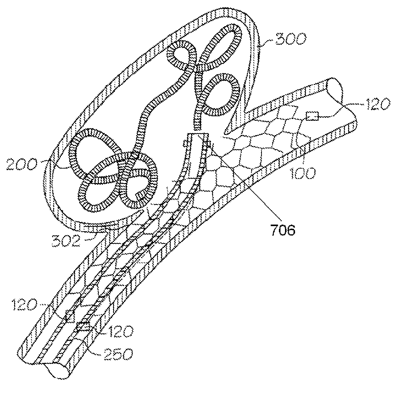 Sacrificial anode stent system