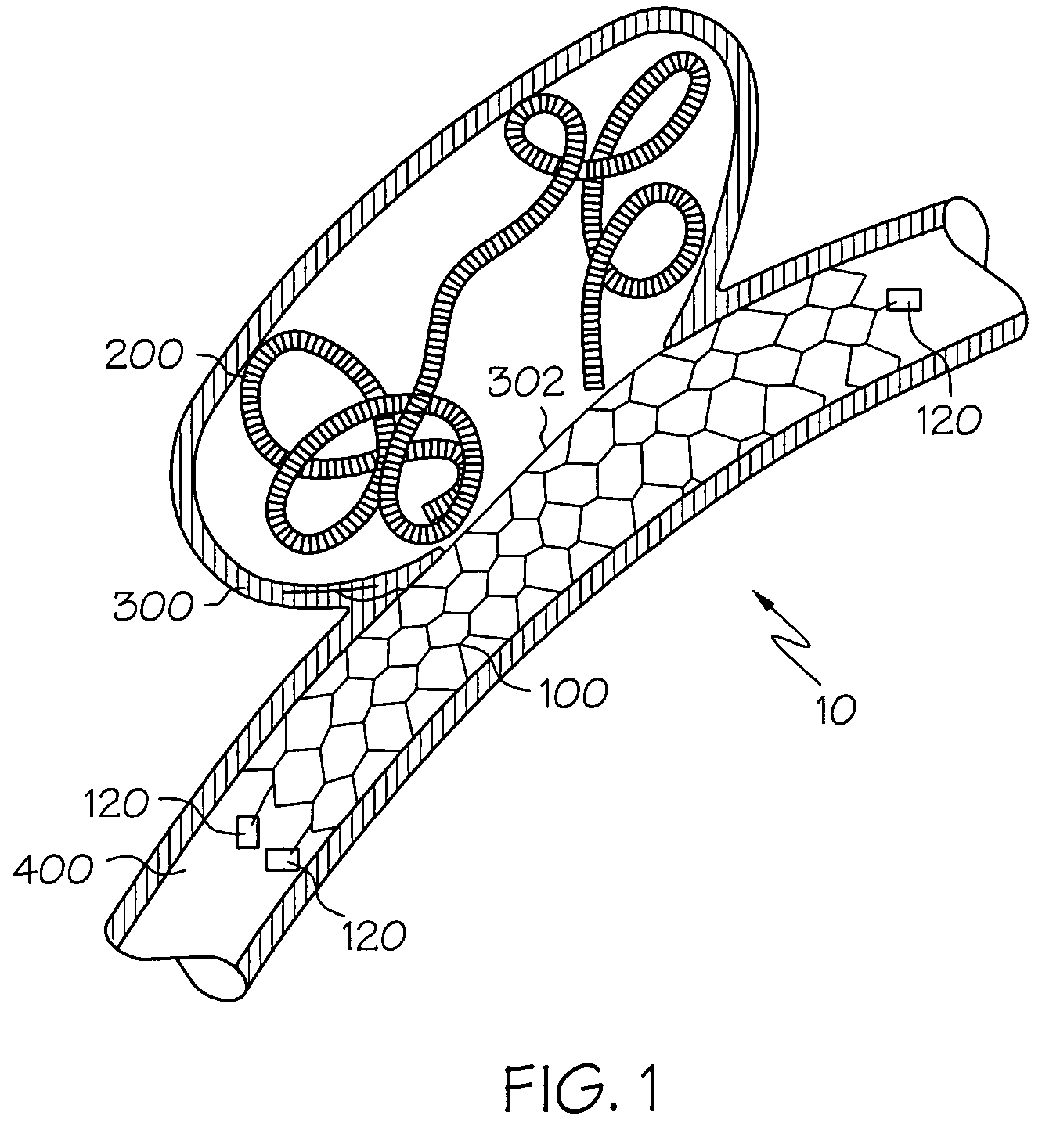 Sacrificial anode stent system