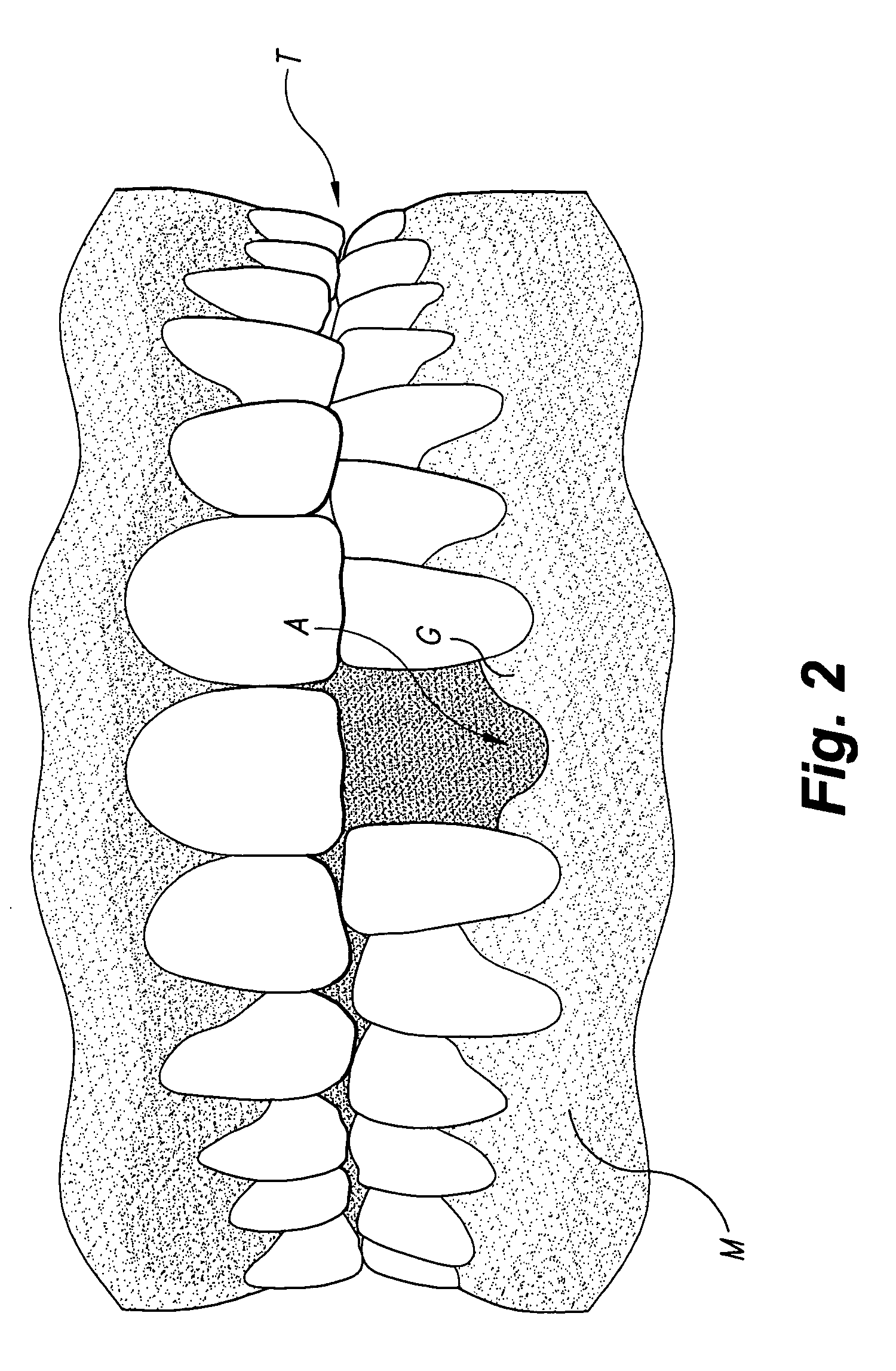 Tunneling method for dental block grafting