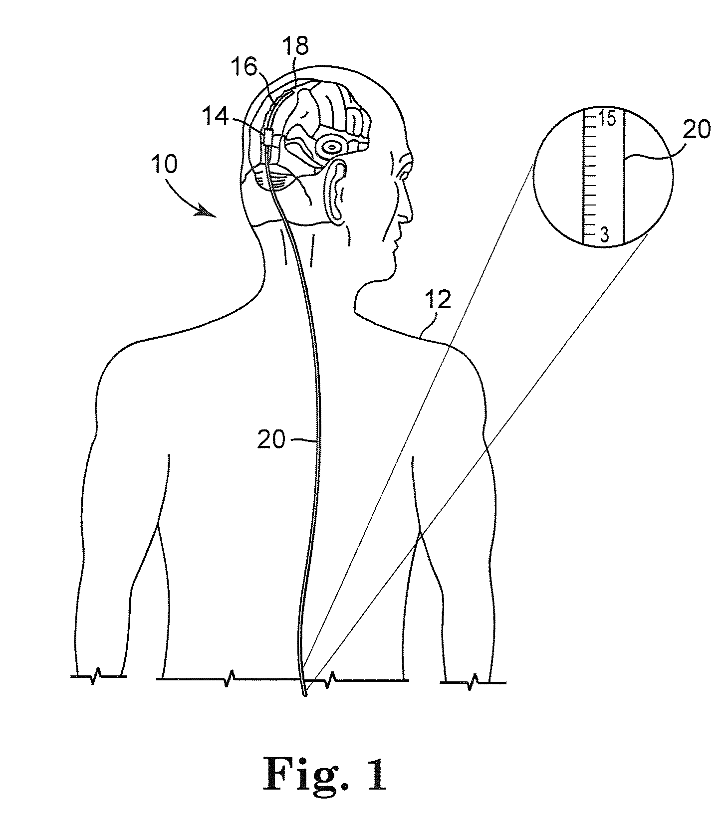 Implantable cerebrospinal fluid flow device and method of controlling flow of cerebrospinal fluid