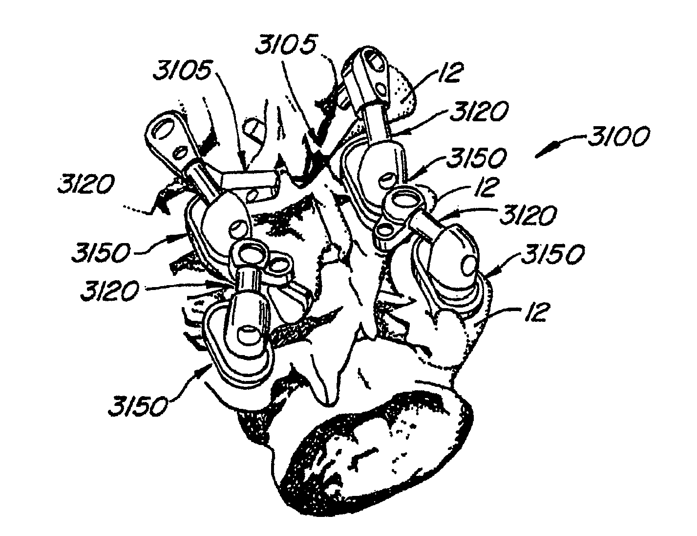 Crossbar spinal prosthesis having a modular design and systems for treating spinal pathologies