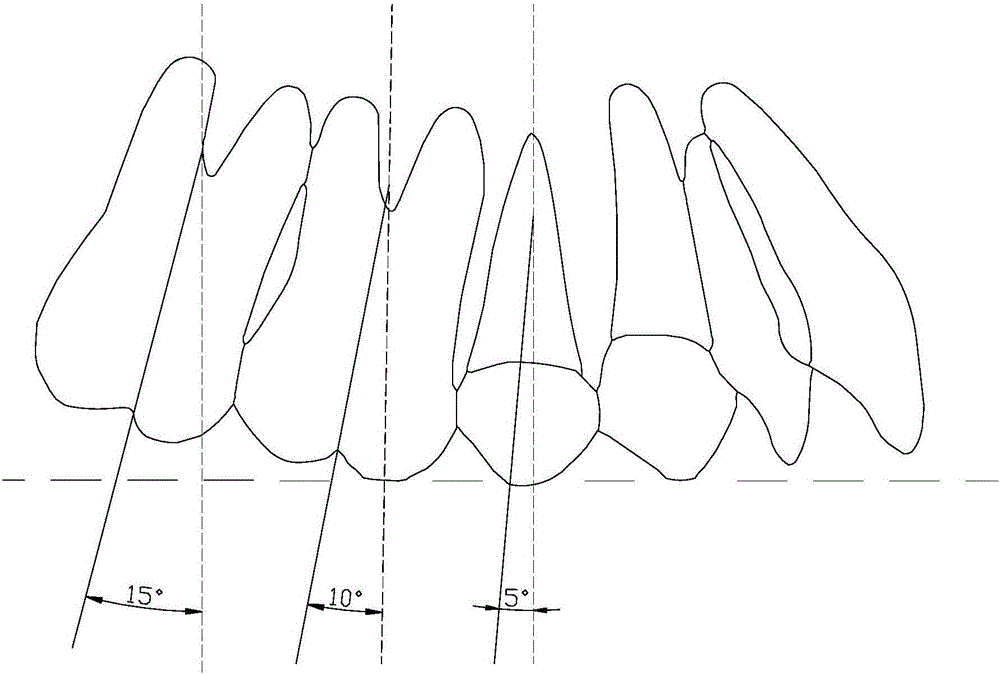 Molar anchorage control method for invisible orthodontic extraction cases