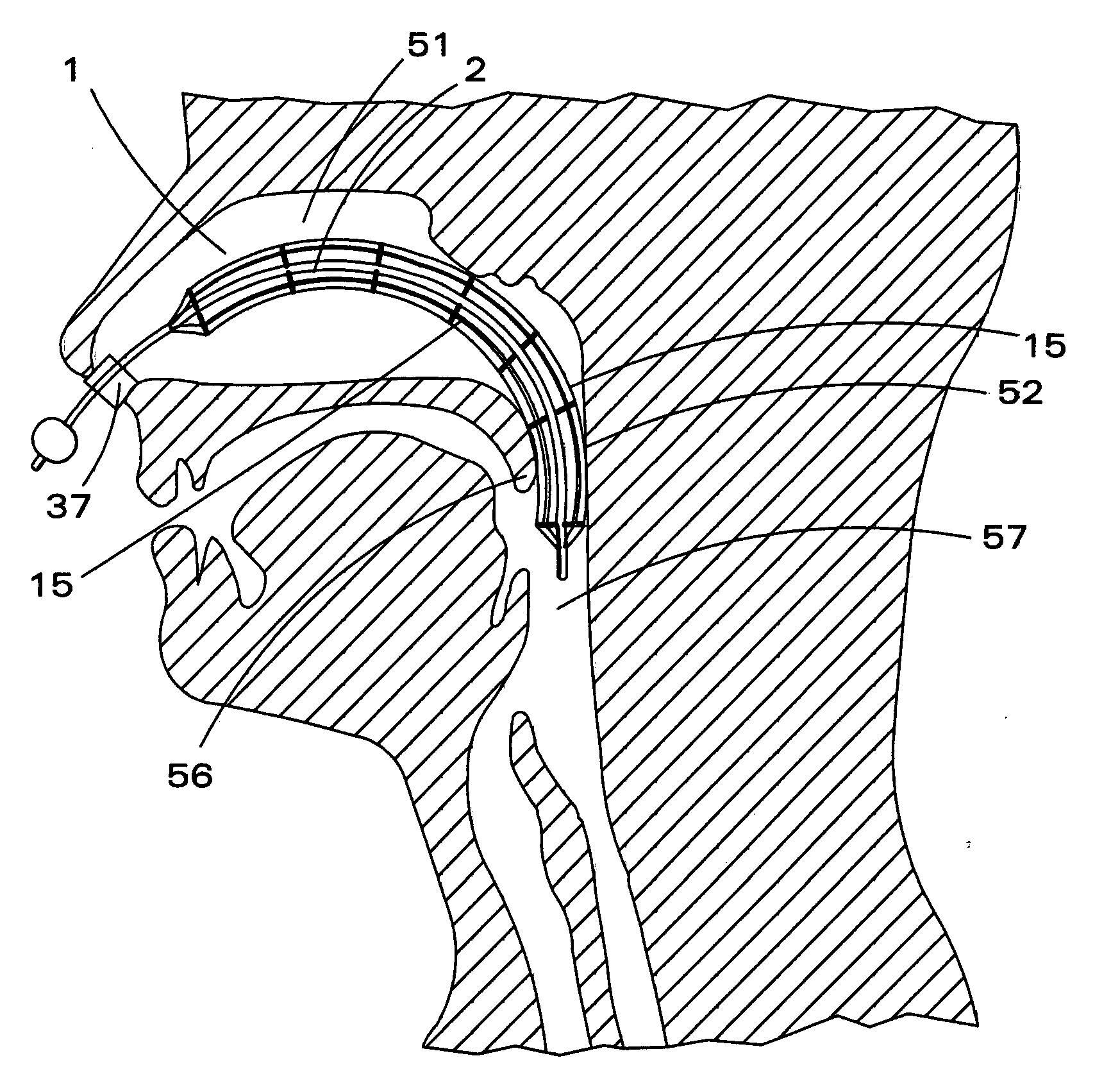 Inflatable nasopharyngeal stent