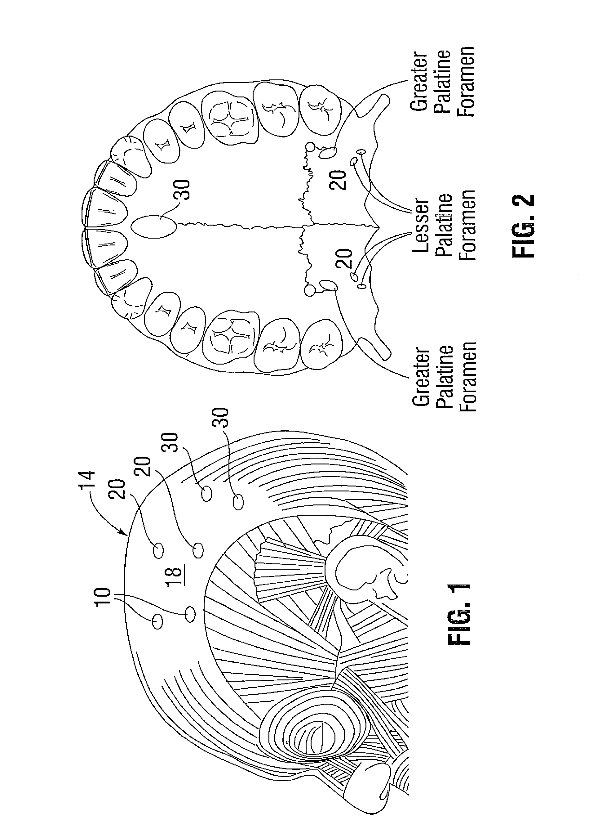 Extramuscular treatment of traumatic-induced migraine headache