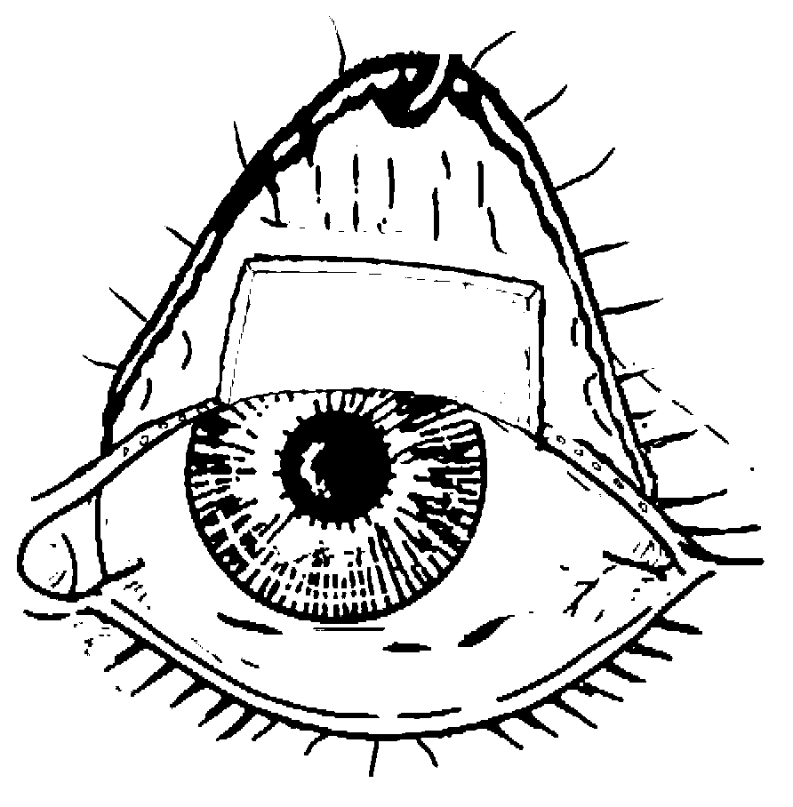 Decellularized eyelid board and preparation method thereof