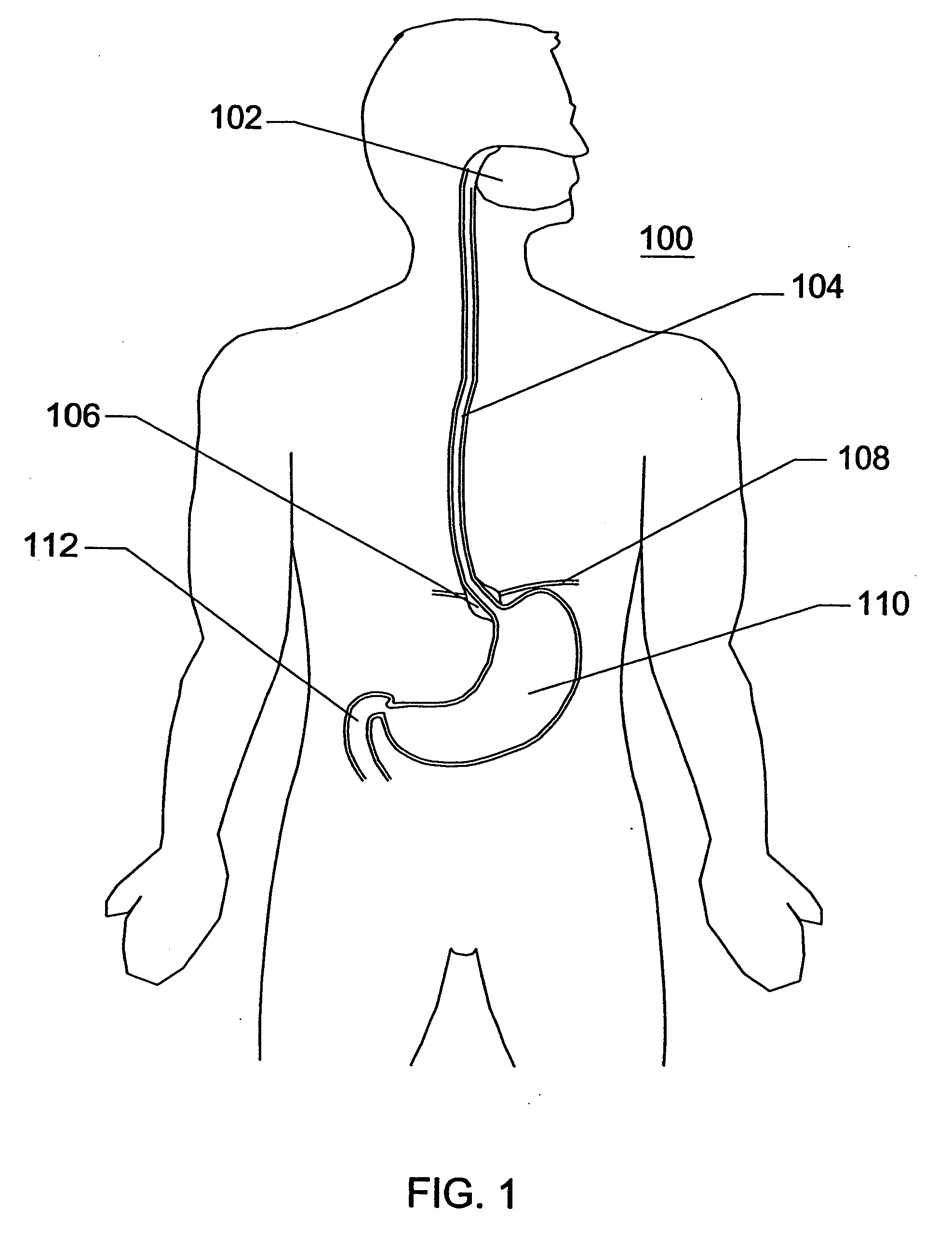 Expandable sheath for percutaneous upper gastrointestinal tract access