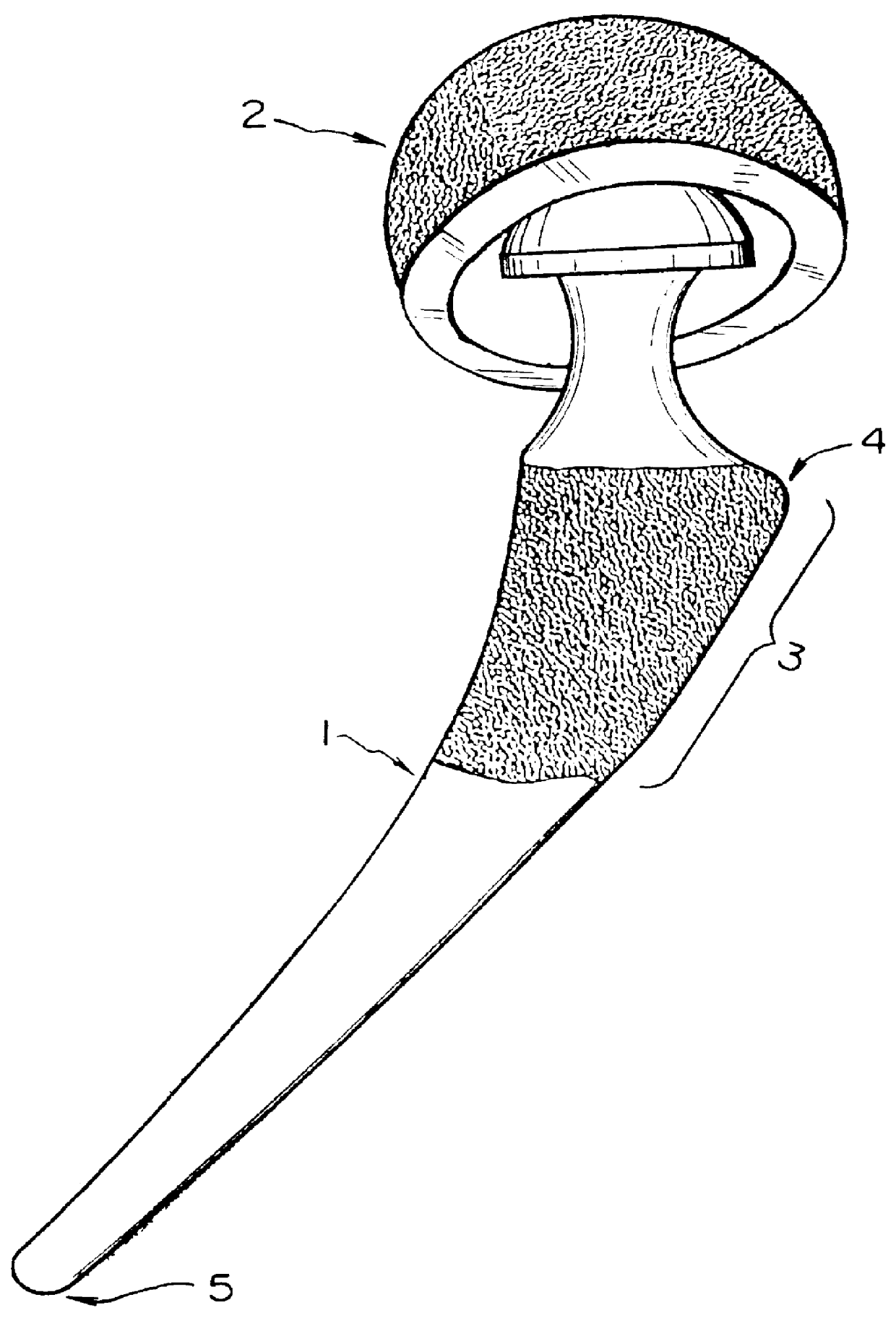 Orthopedic implant system