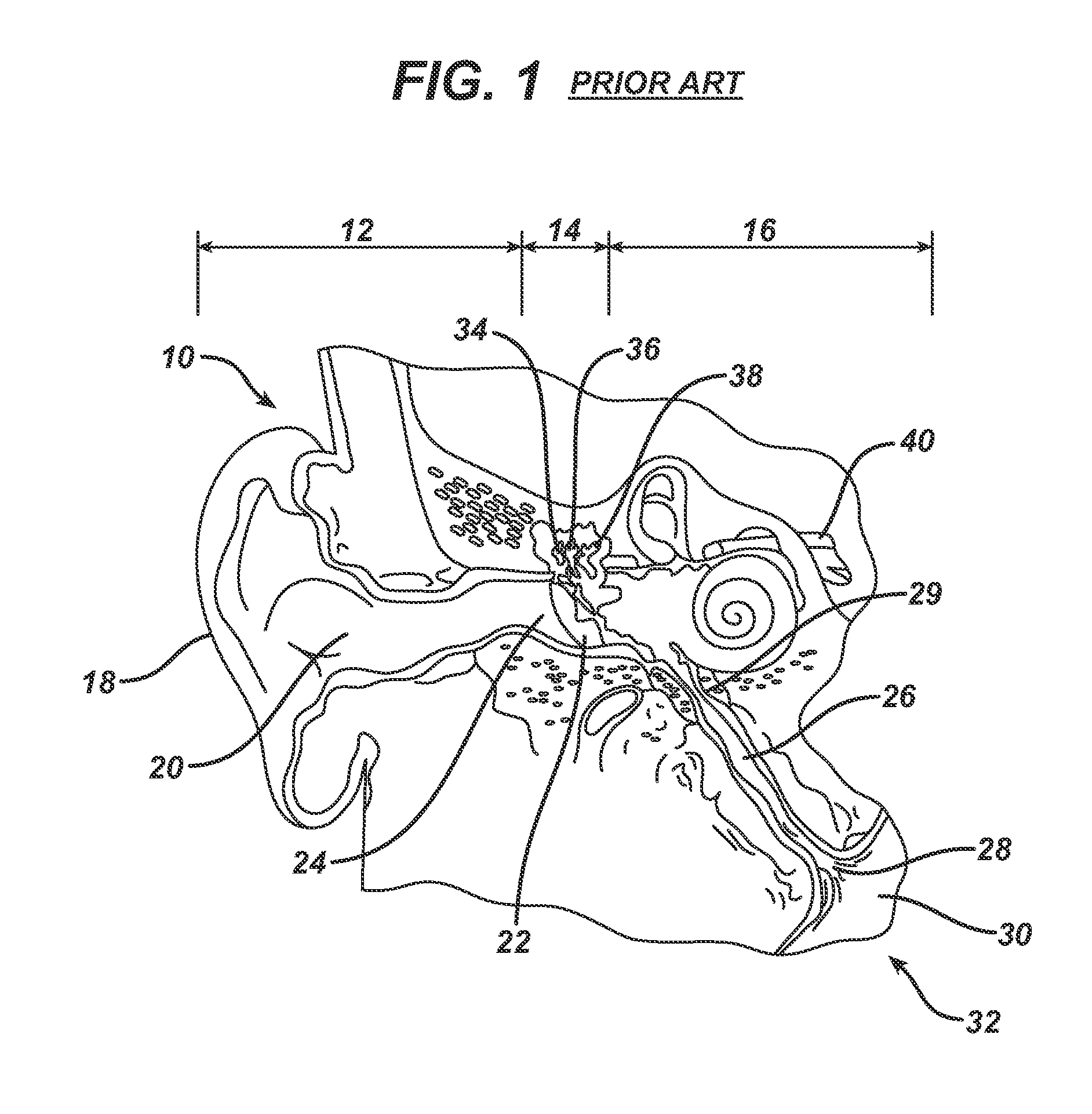 Method and System for Eustachian Tube Dilation