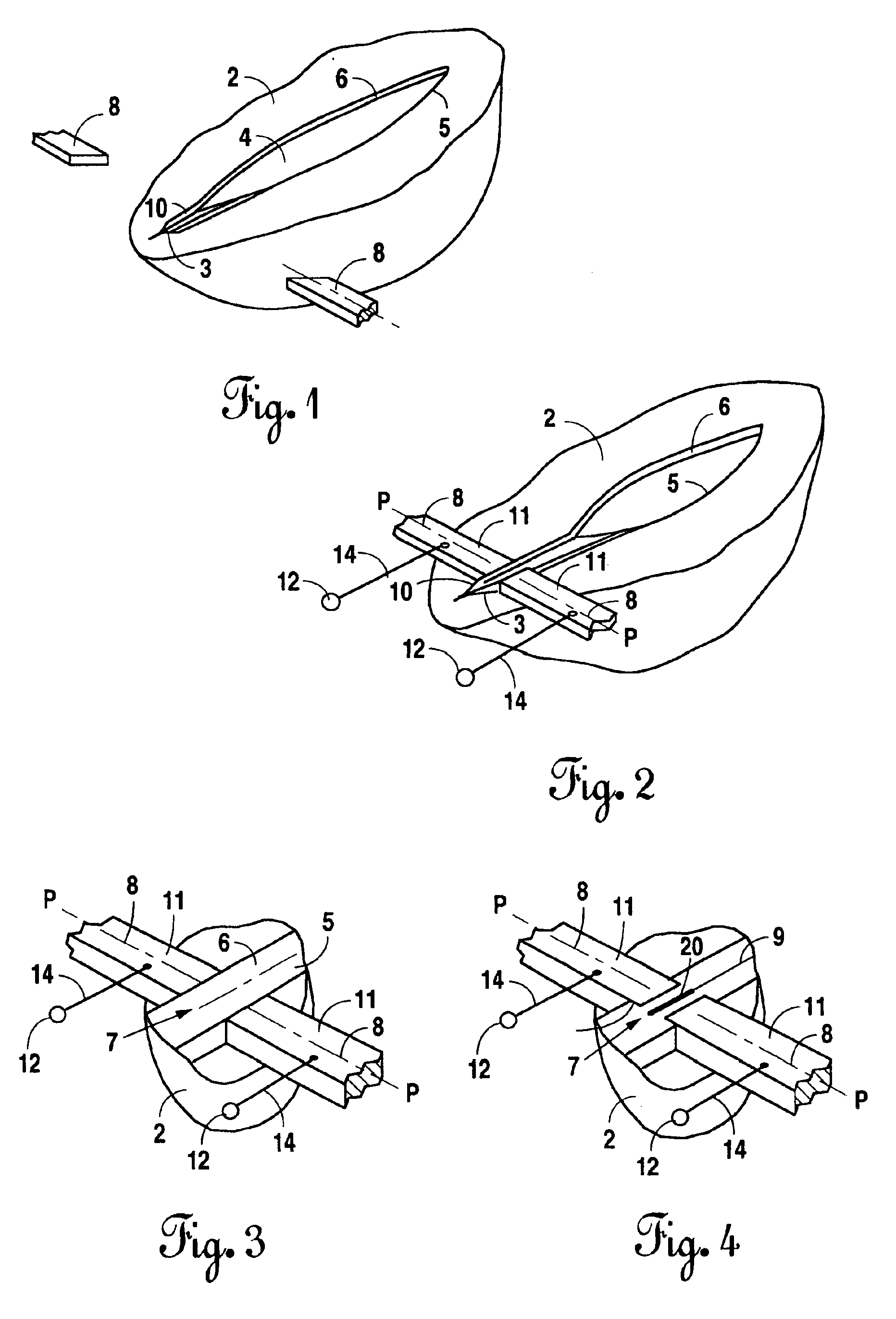 Bonding of soft biological tissues by passing high frequency electric current therethrough