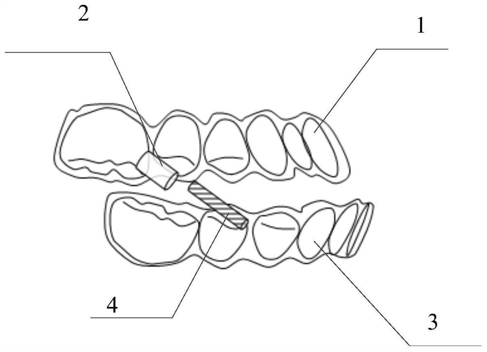 Rod sleeve type lower jaw protraction device