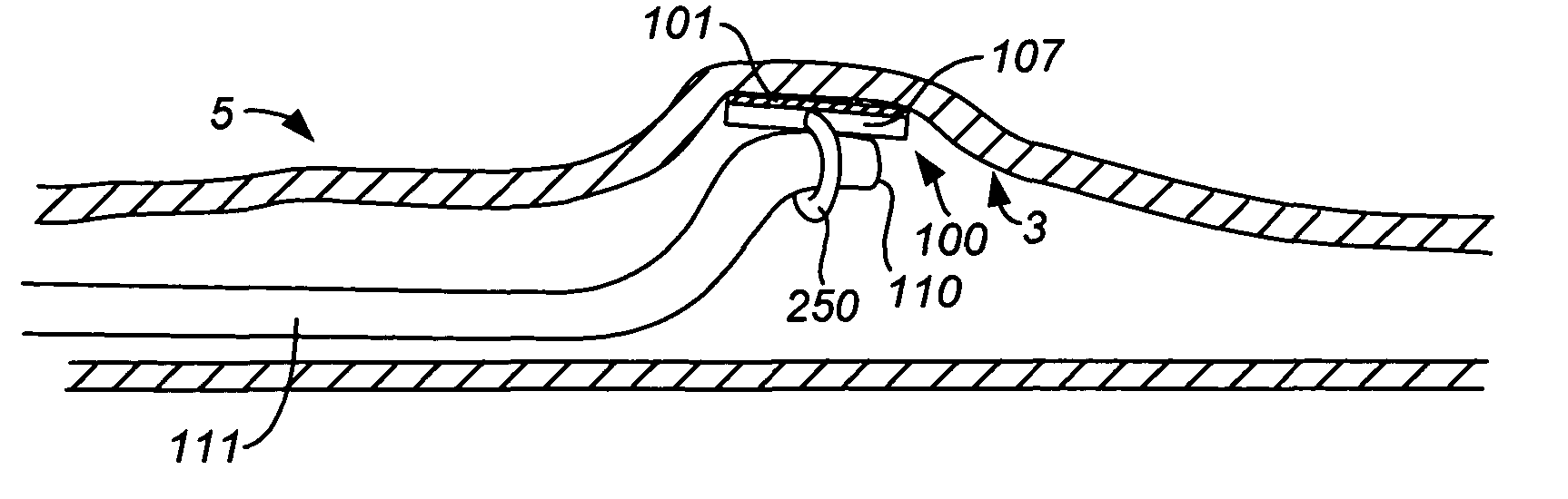 Precision ablating method