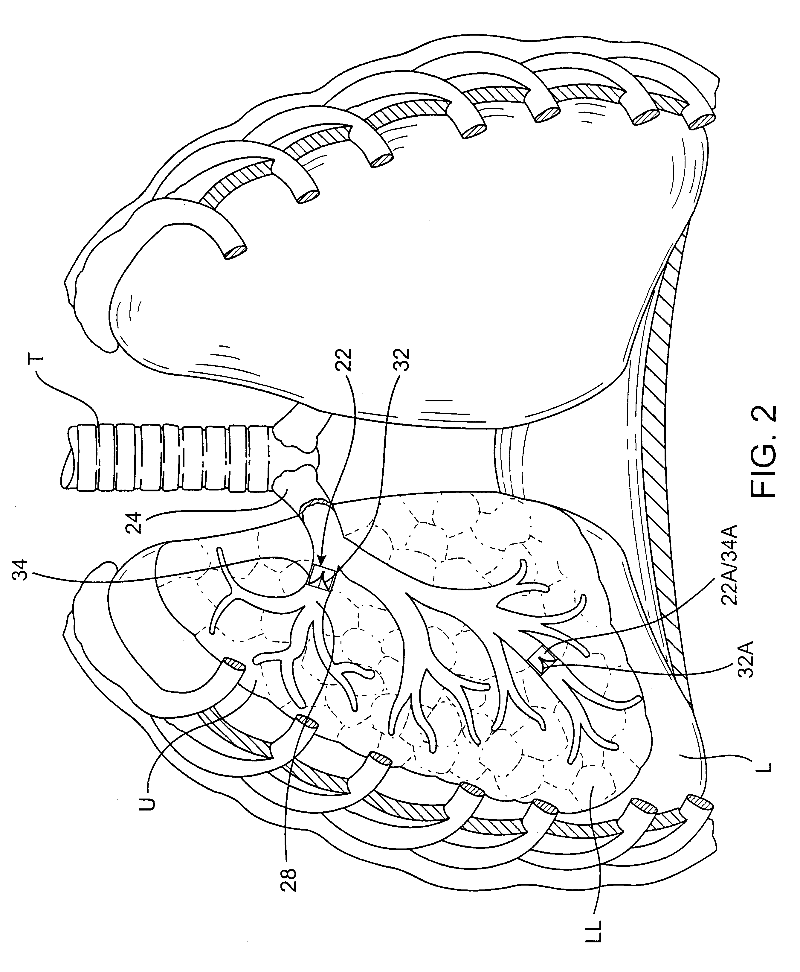 Methods and devices for use in performing pulmonary procedures