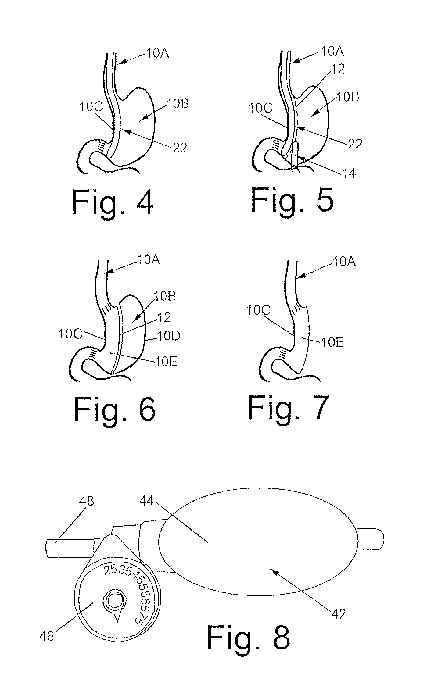 Gastric sizing systems including instruments for use in bariatric surgery