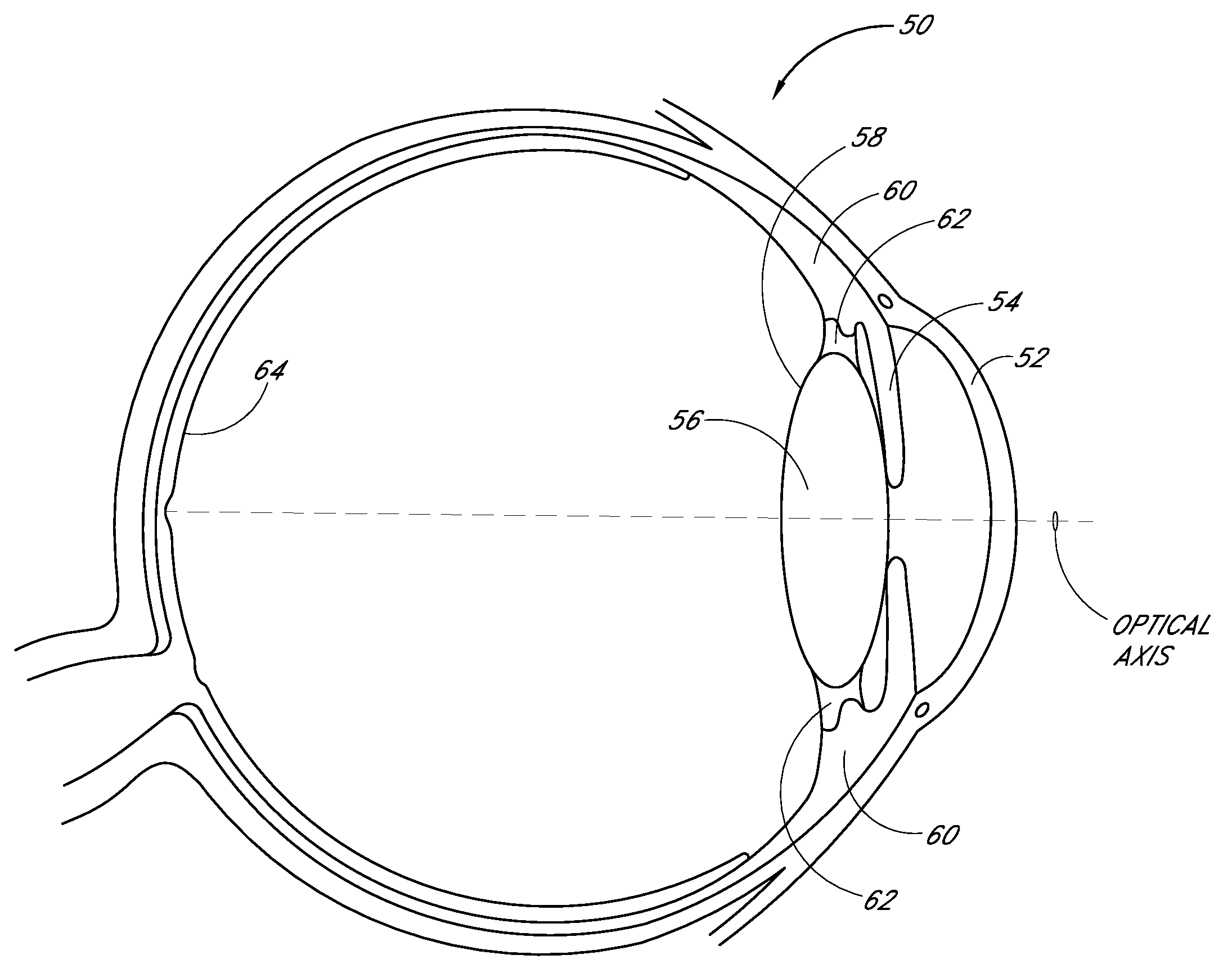 Intraocular lens with post-implantation adjustment capabilities