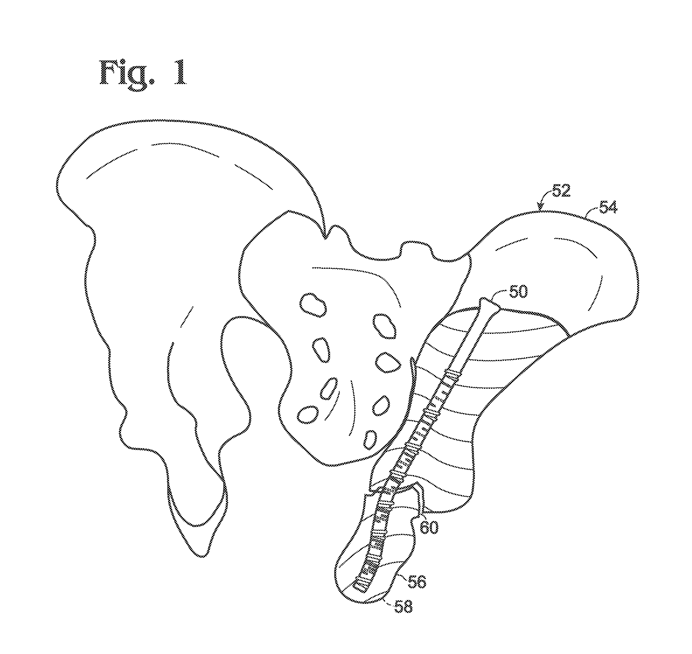 Steerable fastener for bone