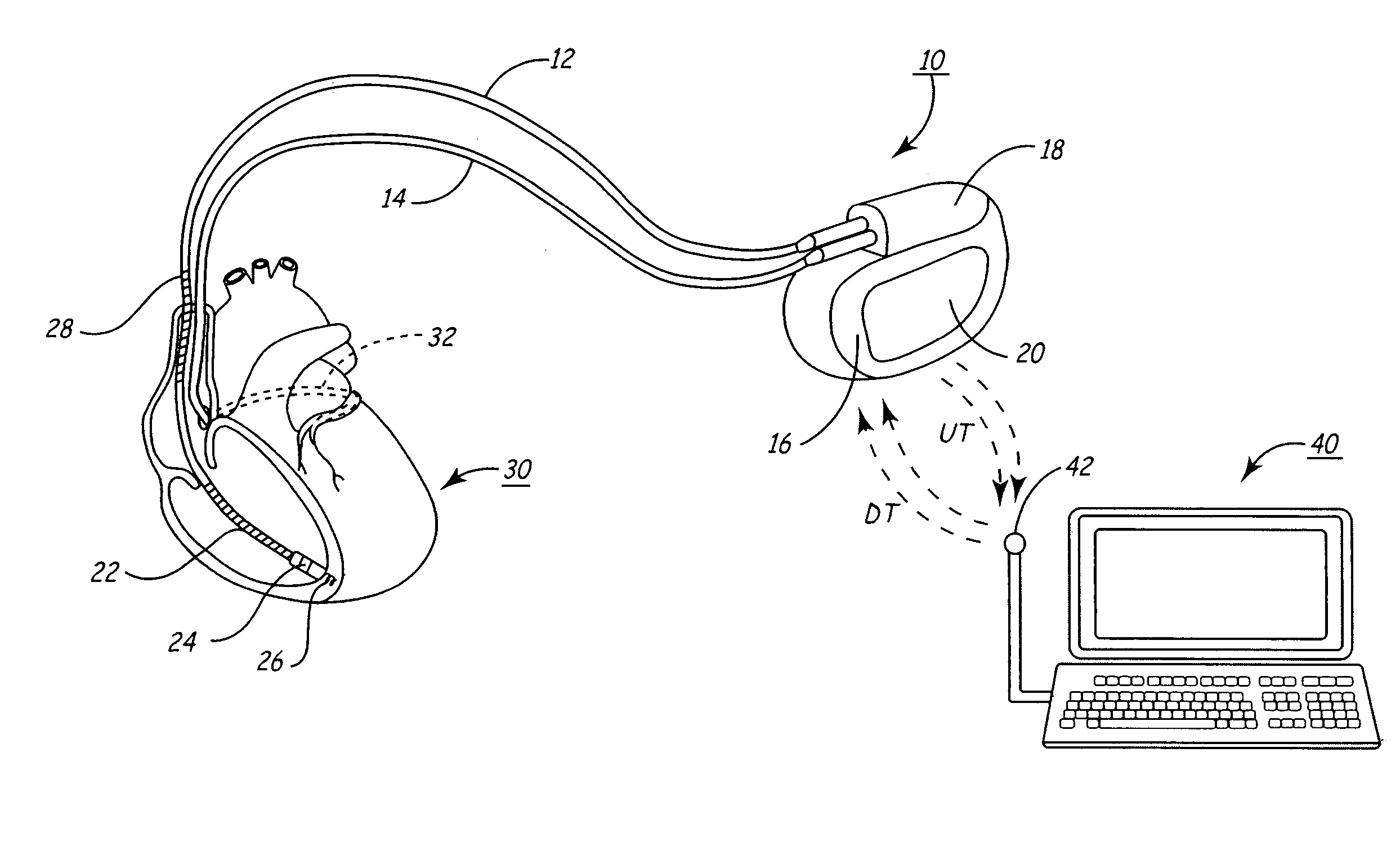 Inter-episode implementation of closed loop ATP