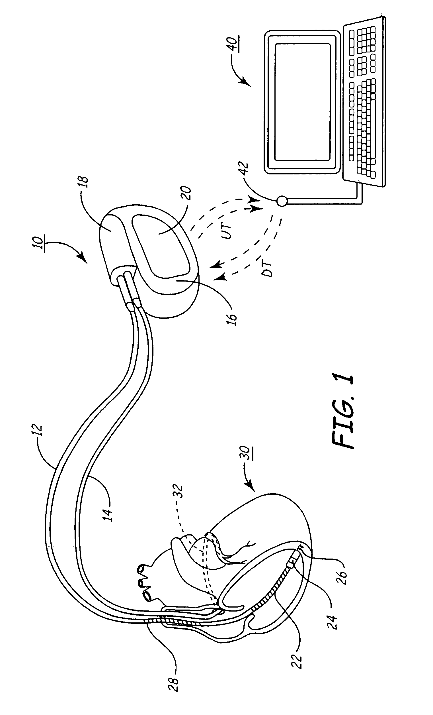 Inter-episode implementation of closed loop ATP