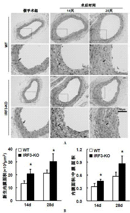 Function and application of IRF3 (Interferon Regulatory Factor 3) to restenosis after stenting and carotid endarterectomy