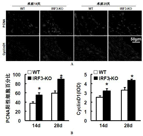 Function and application of IRF3 (Interferon Regulatory Factor 3) to restenosis after stenting and carotid endarterectomy