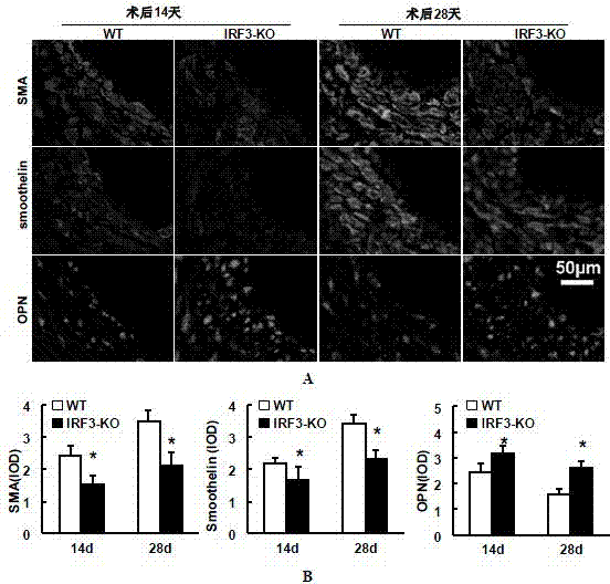 Function and application of IRF3 (Interferon Regulatory Factor 3) to restenosis after stenting and carotid endarterectomy