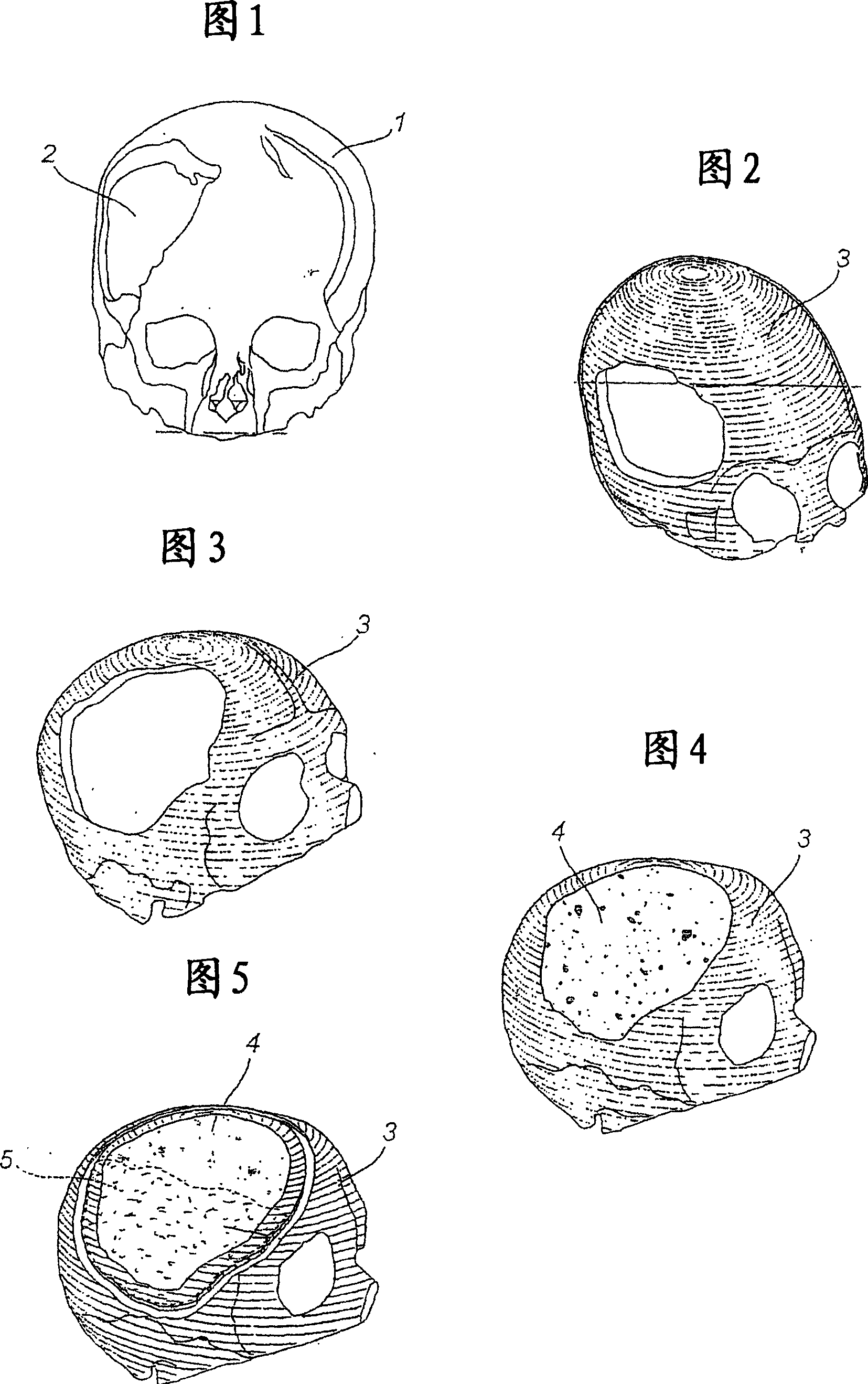 A method for the production of a biologically active prosthetic device for the reconstruction of bone tissue and the prosthetic device itself