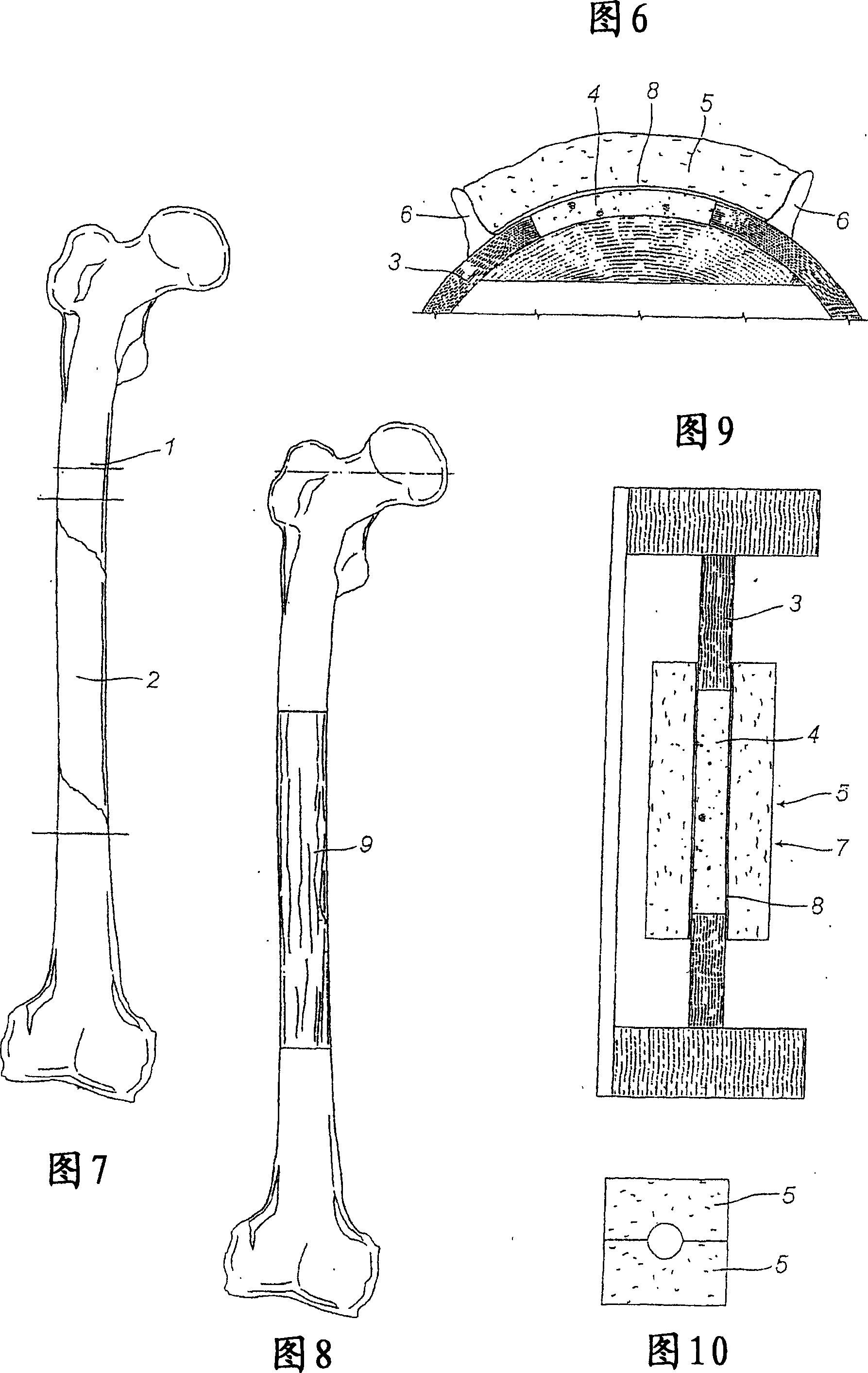 A method for the production of a biologically active prosthetic device for the reconstruction of bone tissue and the prosthetic device itself