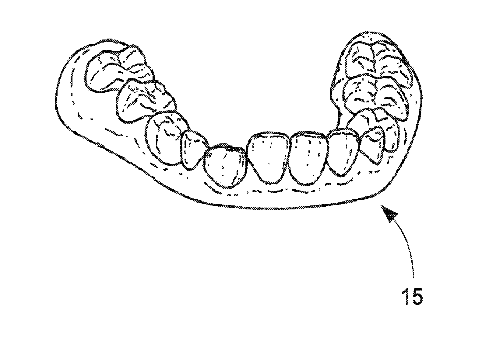 Orthodontic aligner fabrication by overlay method