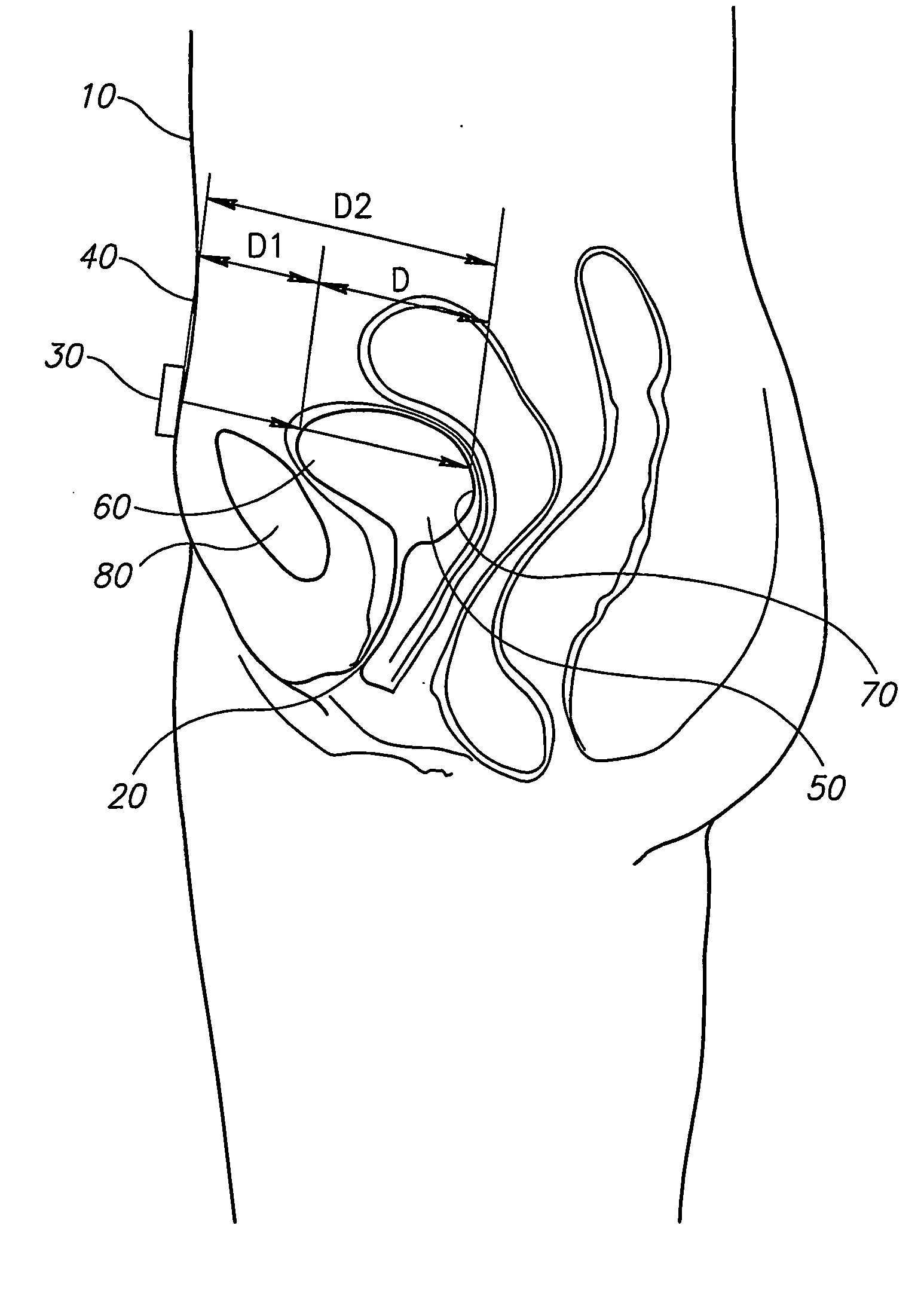 Bladder measurement