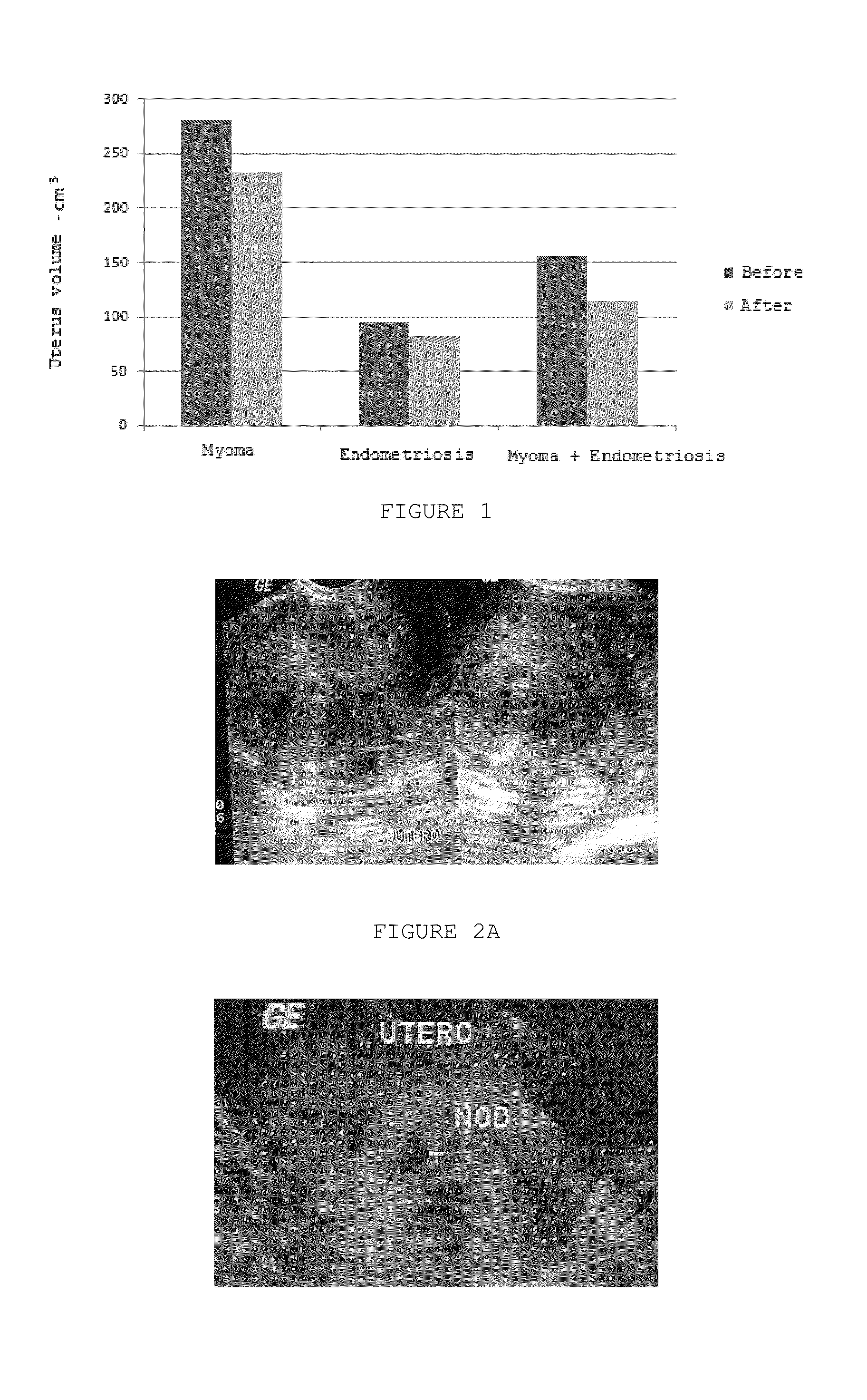 Pharmaceutical Combination of Resveratrol and Progestin to Treat and/or Prevent Myoma and/or Endometriosis